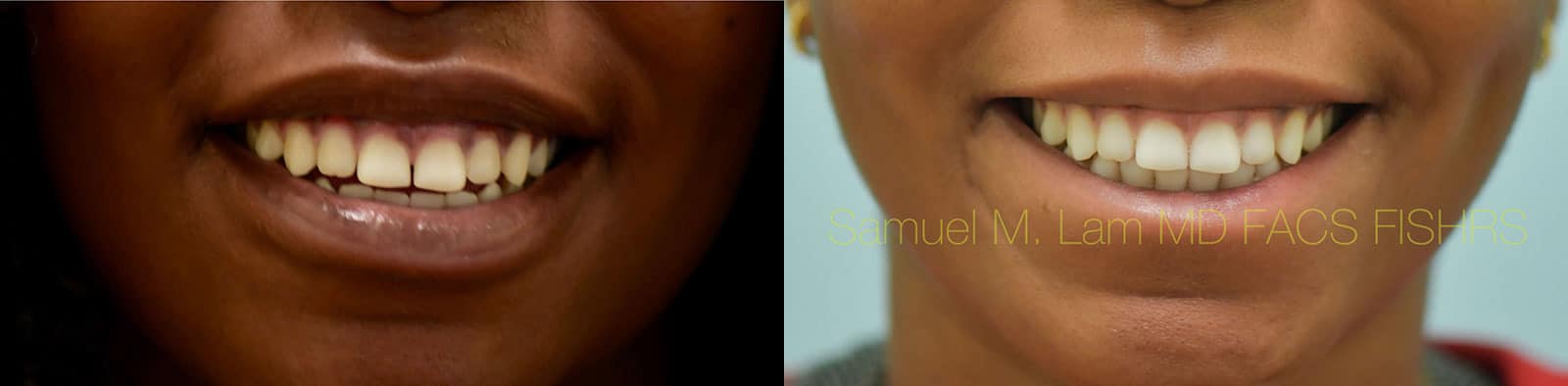 Lip Reduction Before and After Photo by Dr. Lam in Plano TX