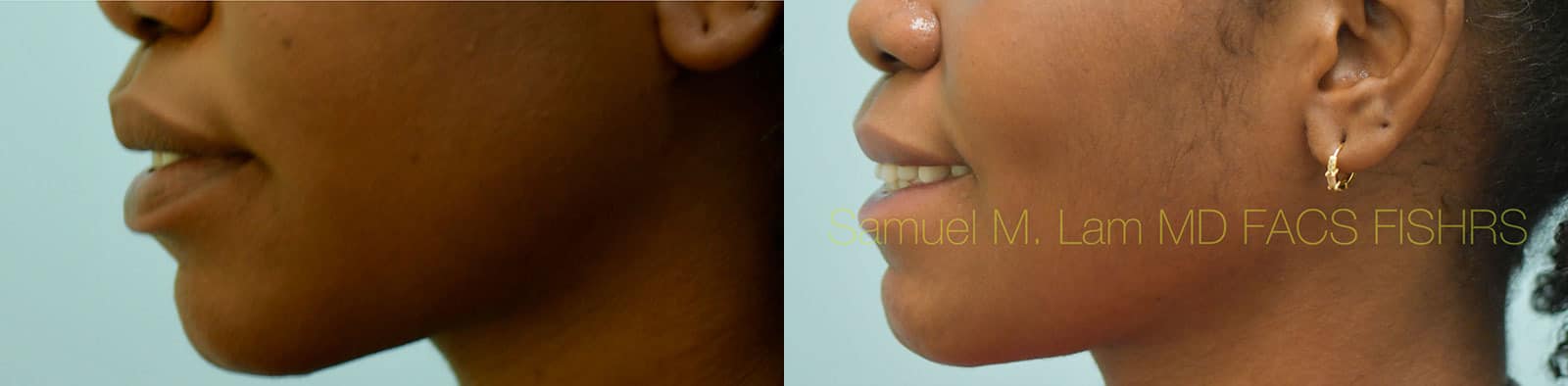 Lip Reduction Before and After Photo by Dr. Lam in Plano TX