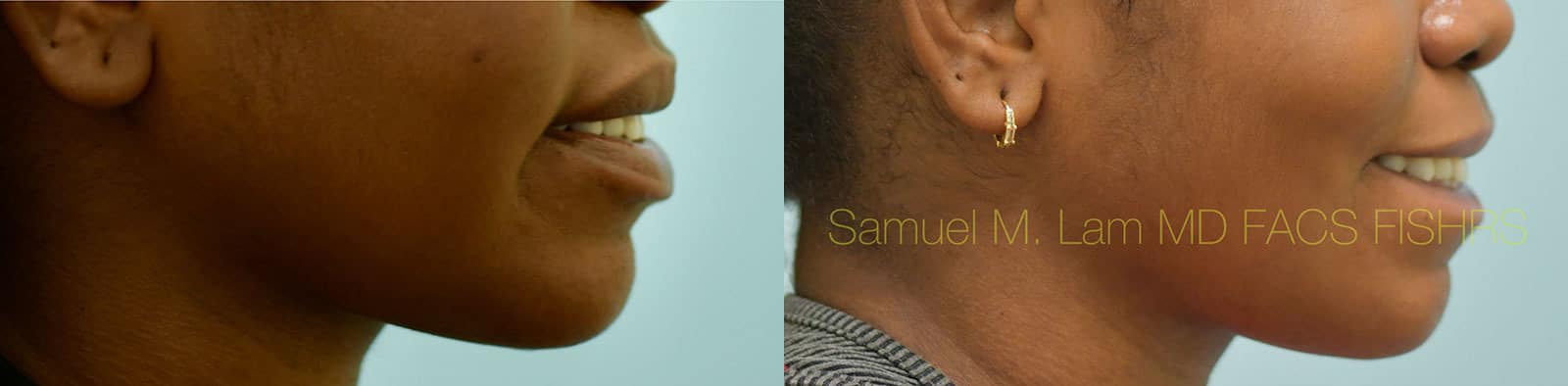 Lip Reduction Before and After Photo by Dr. Lam in Plano TX