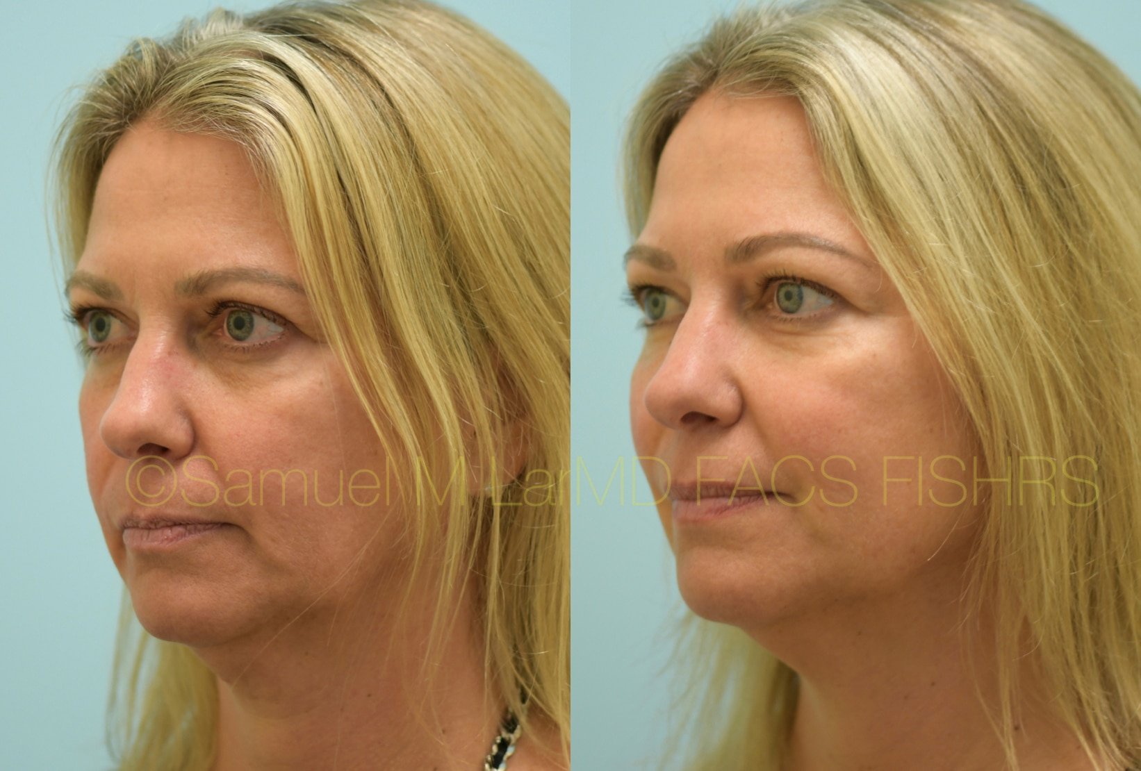 Botox