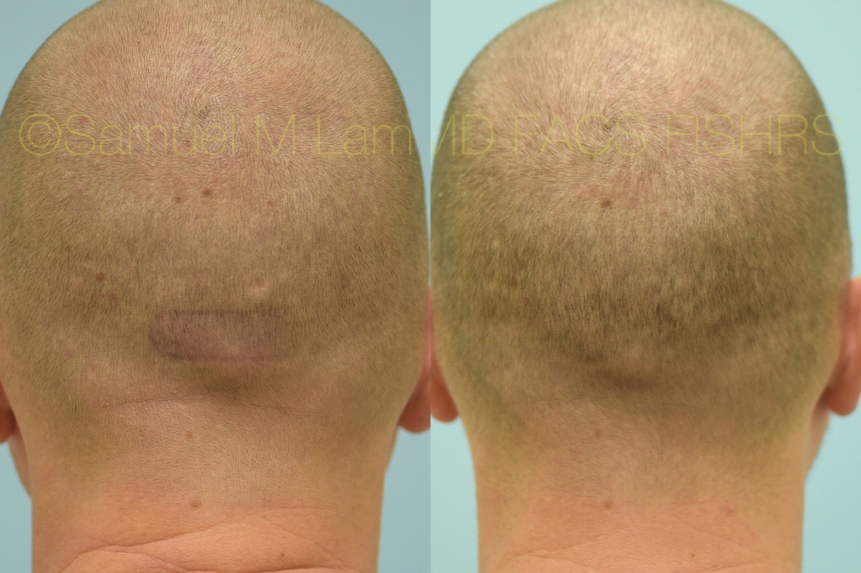 of Scar Revision