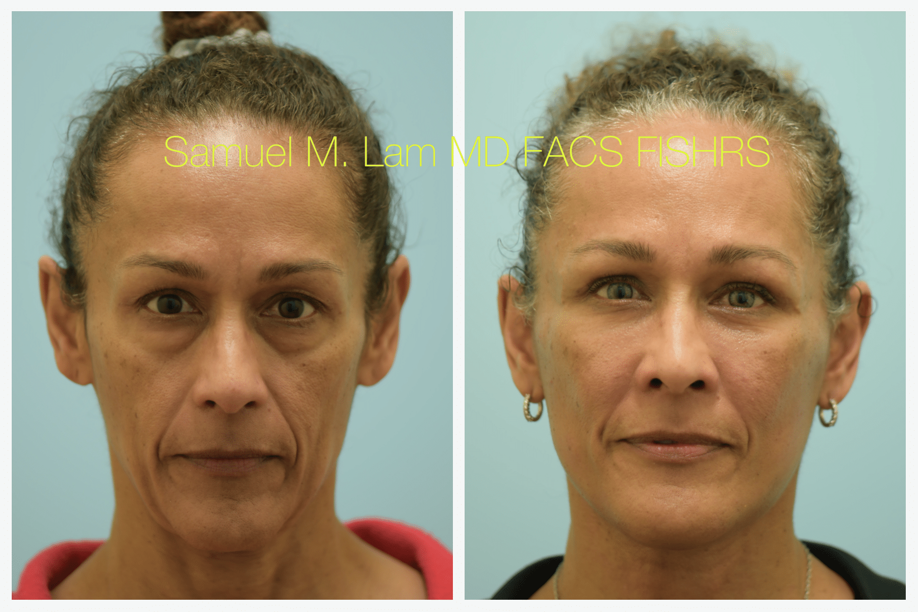 blepharoplasty before and after 1 of 4