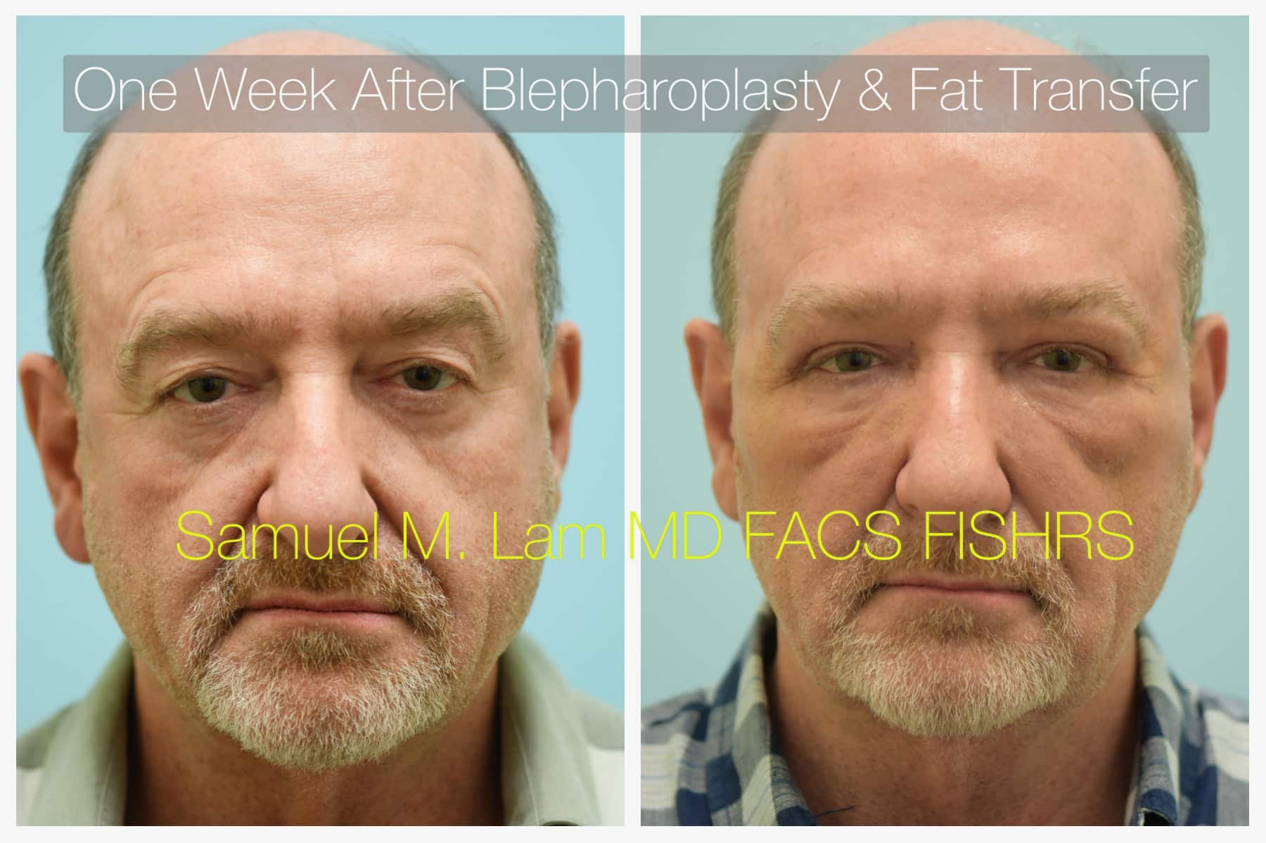 fat grafting blepharoplasty before and after photos - Dr. Sam Lam - Dallas, TX fat grafting blepharoplasty before and after photos - Dr. Sam Lam - Dallas, TX