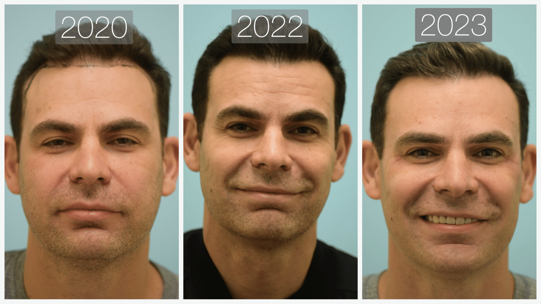 Botox and Fillers BxA Botox and Fillers BxA