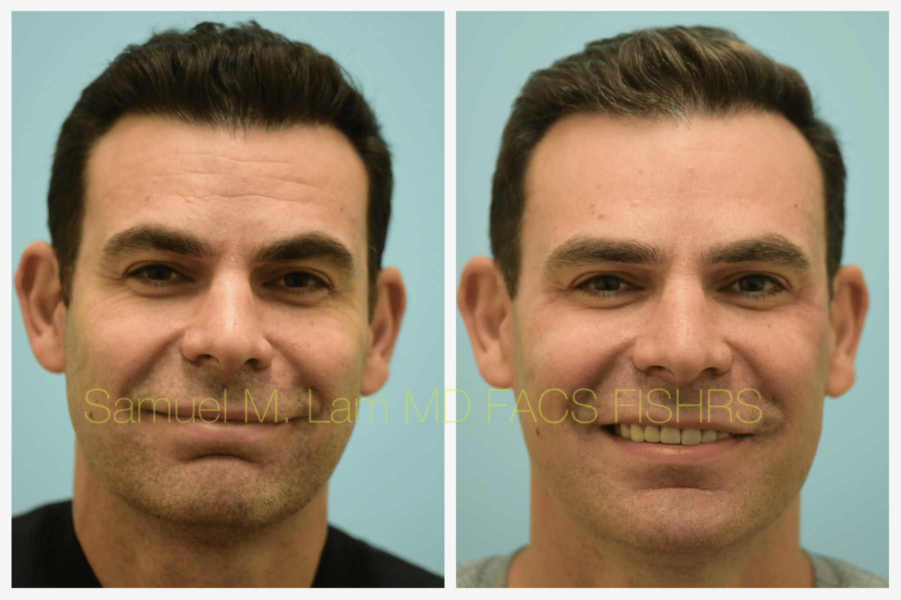 Botox and Fillers before and after Botox and Fillers before and after