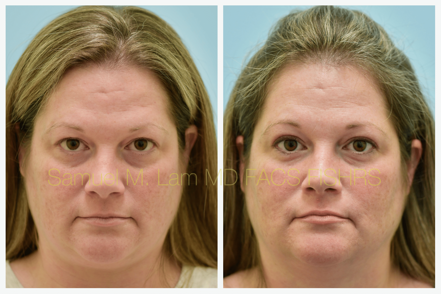 blepharoplasty before and after