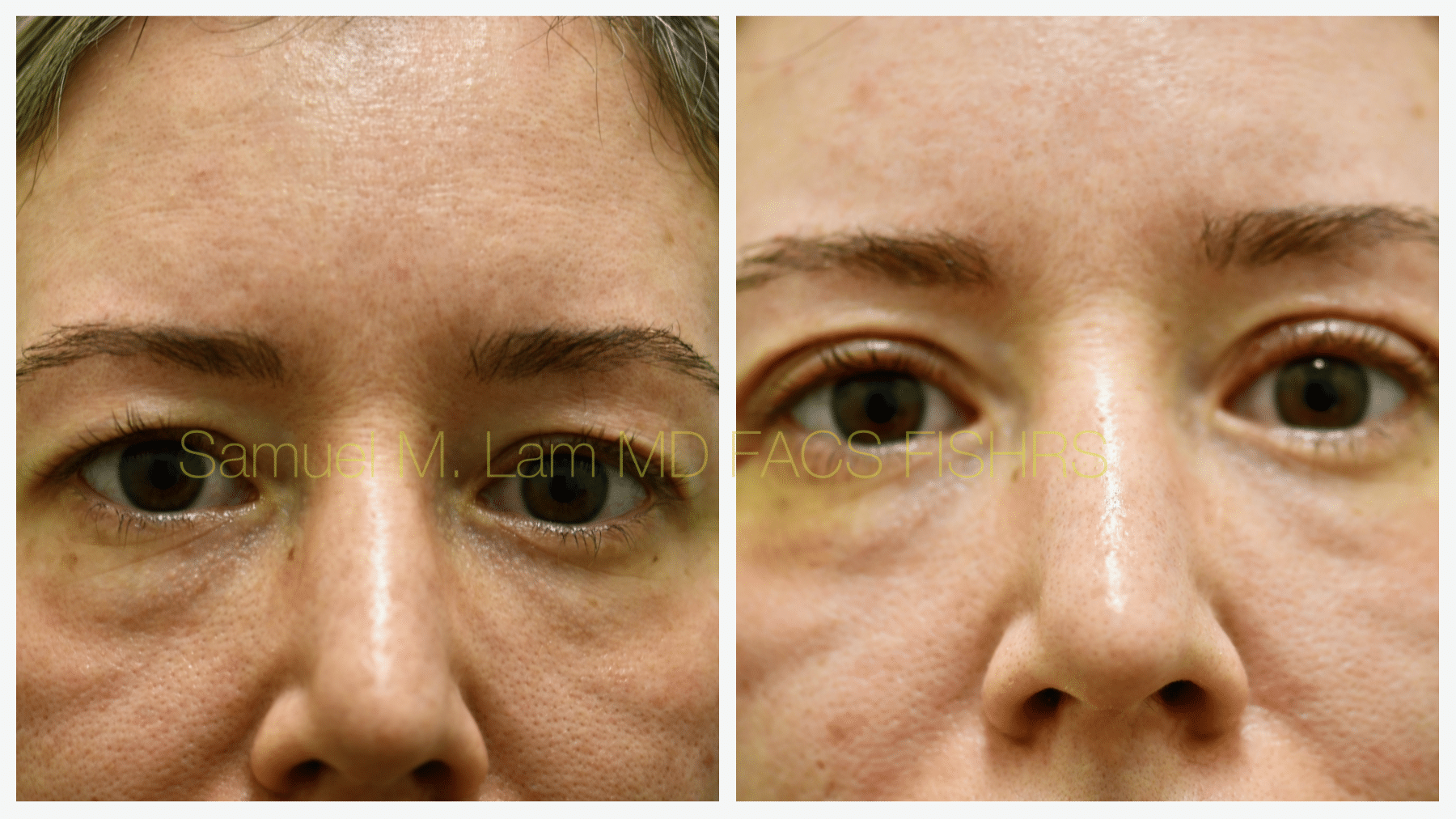Dr Lams blepharoplasty Bxa close up Dr Lams blepharoplasty Bxa close up