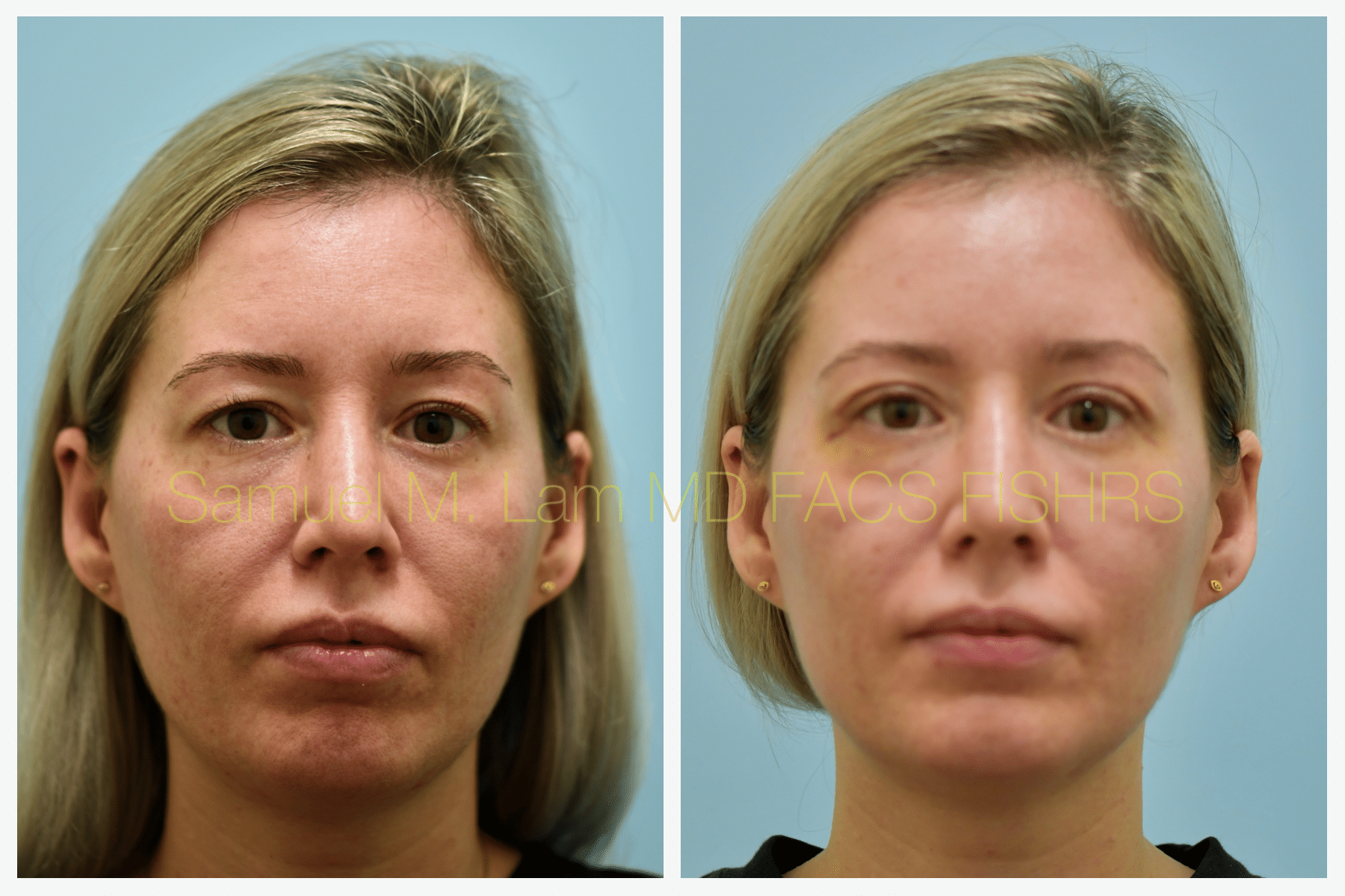 Dr Lams blepharoplasty Bxa Dr Lams blepharoplasty Bxa