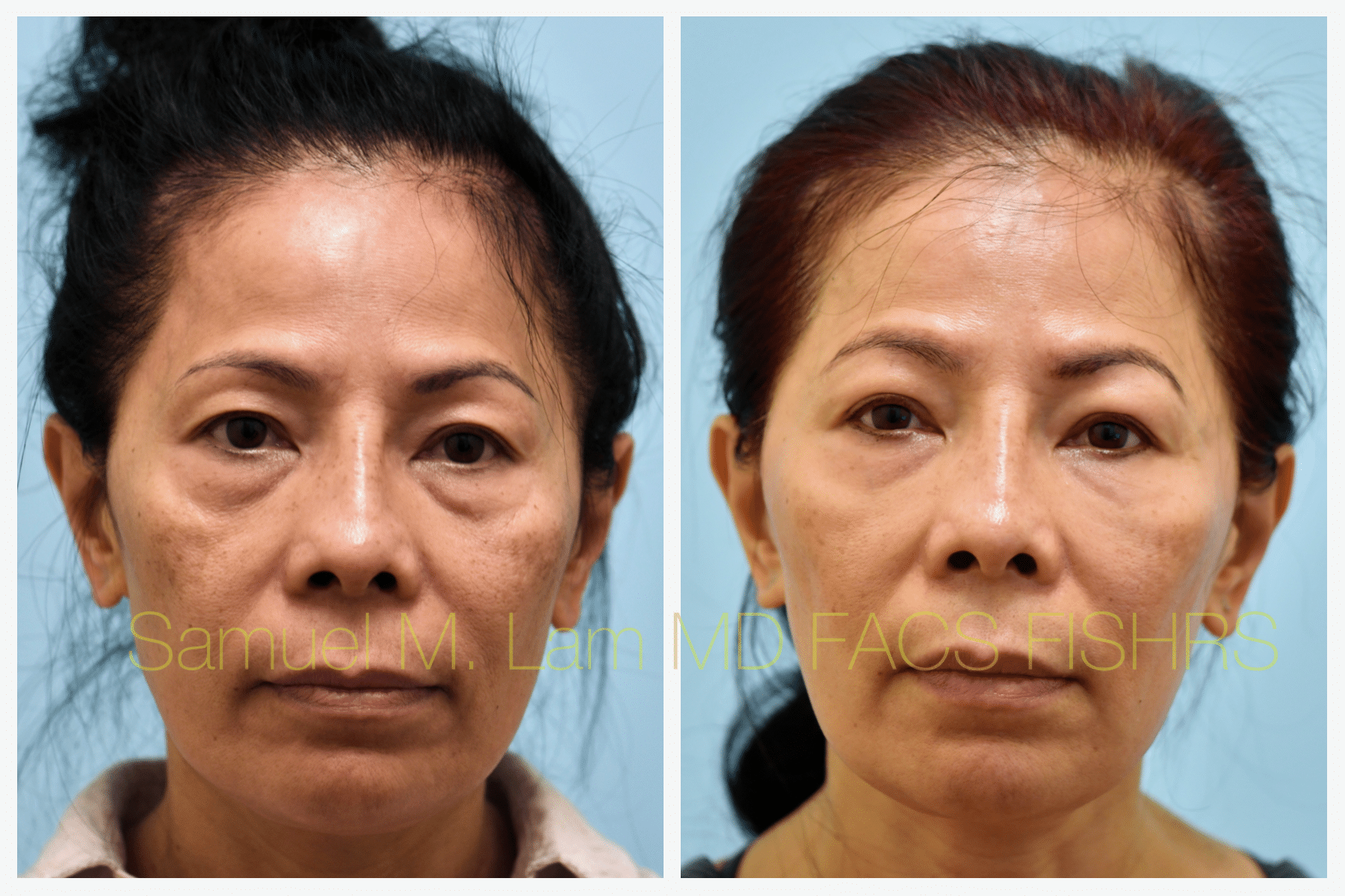 Facial Fat Transfer