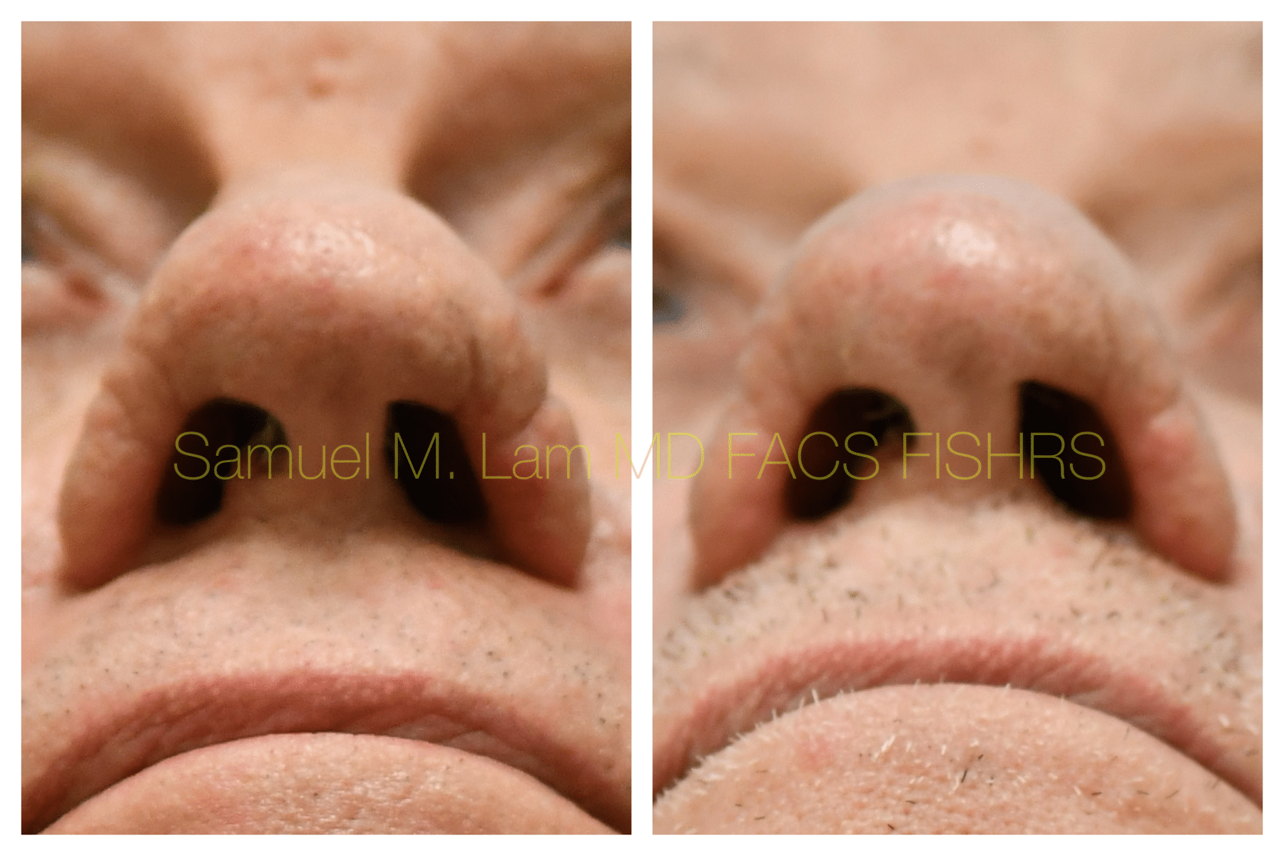 Rhinopyma Before and After Photo by Dr. Lam in Plano TX Rhinopyma Before and After Photo by Dr. Lam in Plano TX