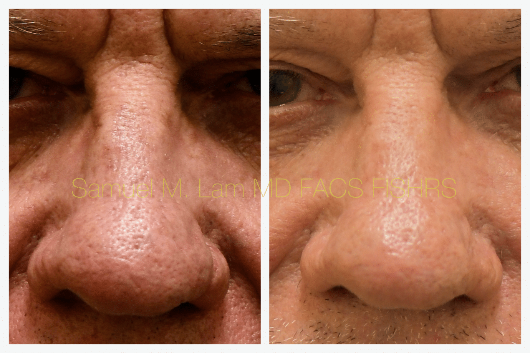 Rhinopyma Before and After Photo by Dr. Lam in Plano TX Rhinopyma Before and After Photo by Dr. Lam in Plano TX