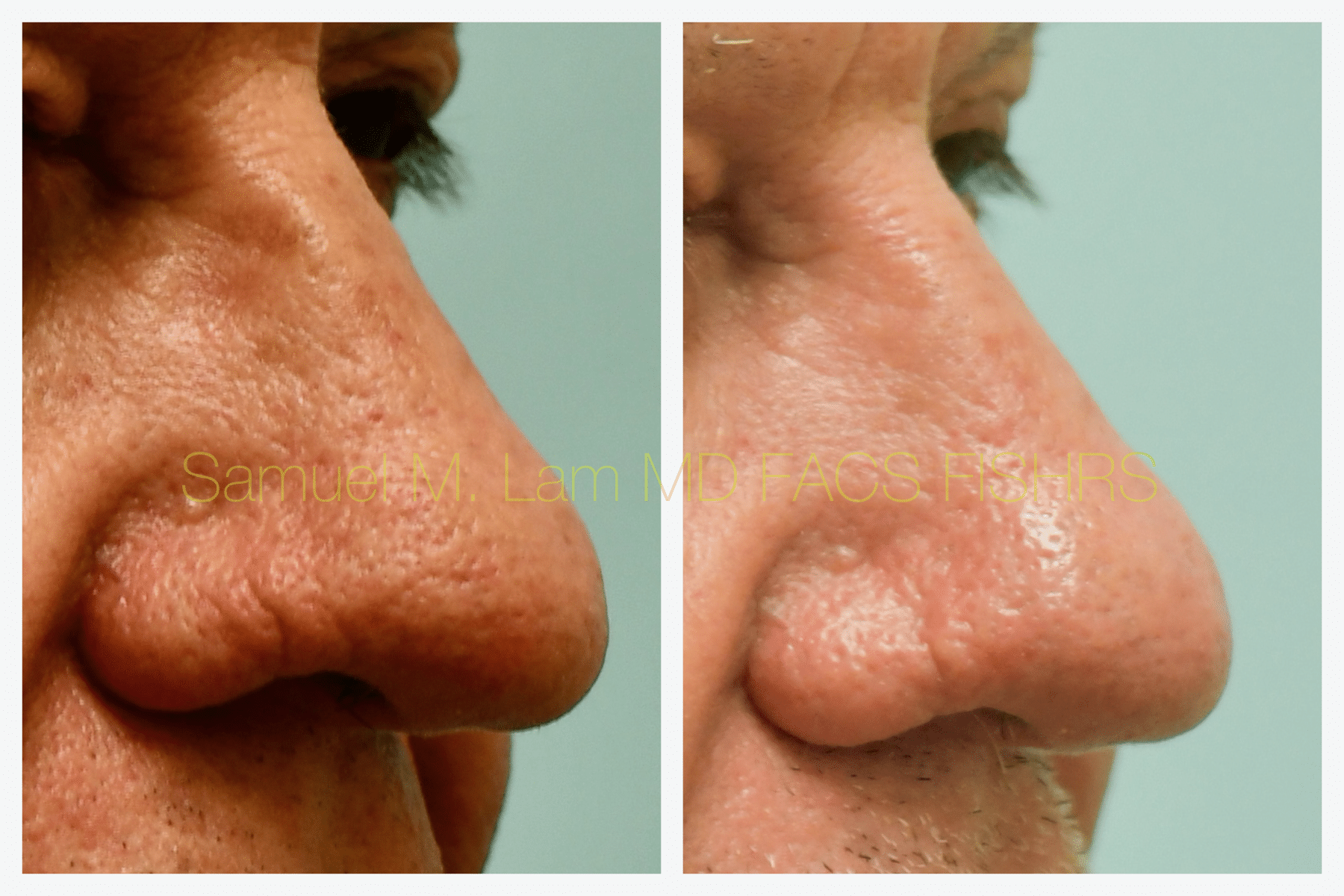 Rhinopyma Before and After Photo by Dr. Lam in Plano TX Rhinopyma Before and After Photo by Dr. Lam in Plano TX