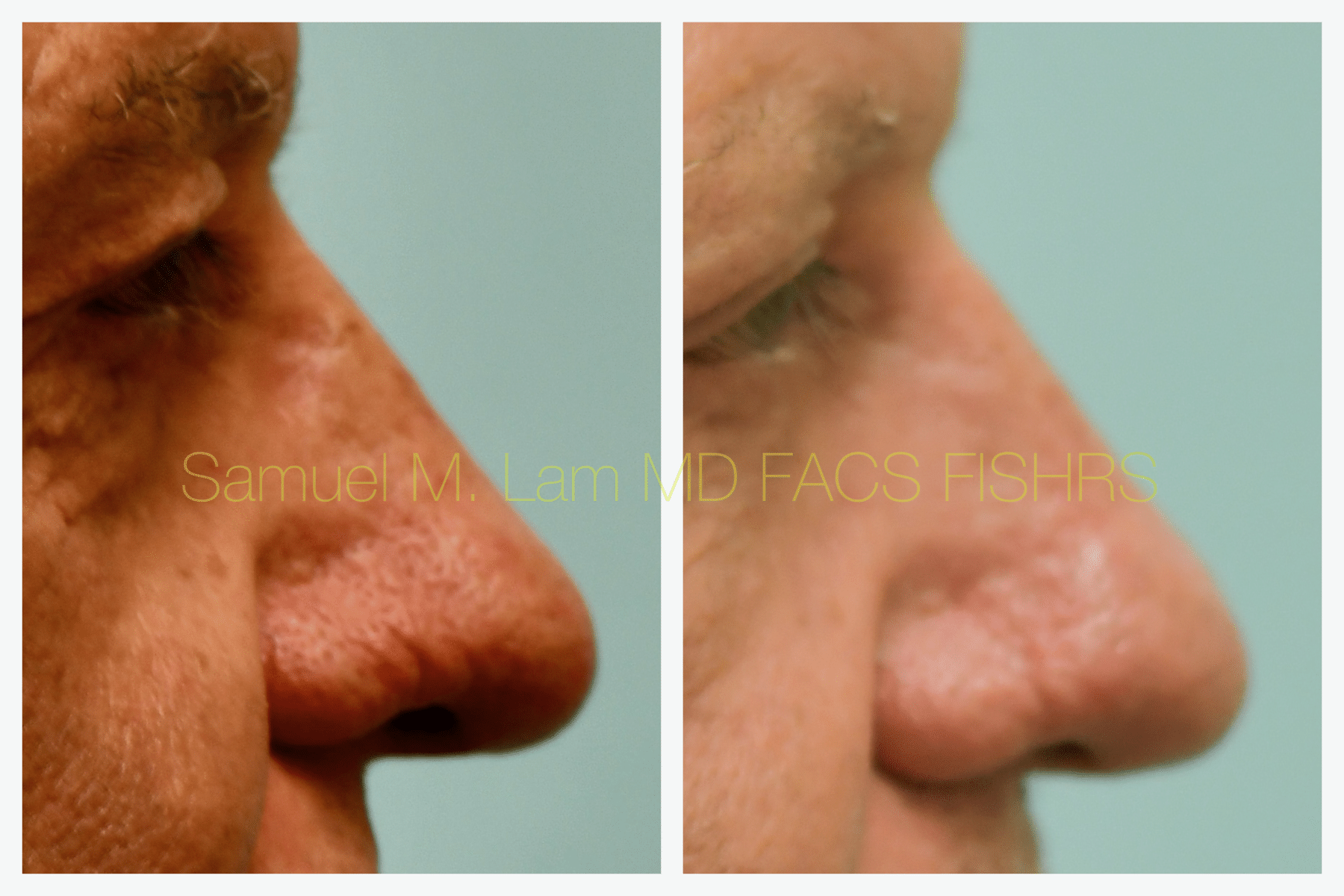 Rhinopyma Before and After Photo by Dr. Lam in Plano TX Rhinopyma Before and After Photo by Dr. Lam in Plano TX