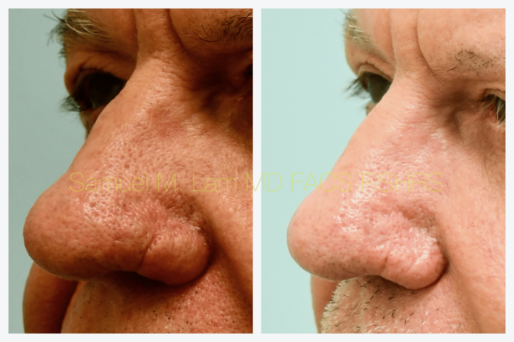 Rhinopyma Before and After Photo by Dr. Lam in Plano TX Rhinopyma Before and After Photo by Dr. Lam in Plano TX
