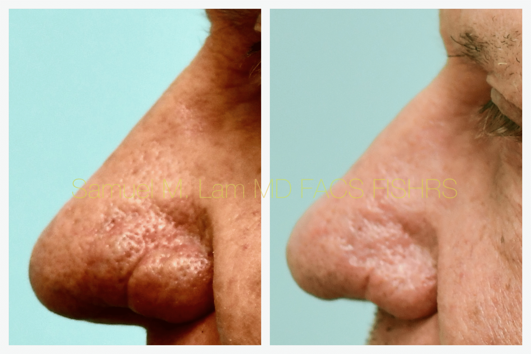 Rhinopyma Before and After Photo by Dr. Lam in Plano TX Rhinopyma Before and After Photo by Dr. Lam in Plano TX