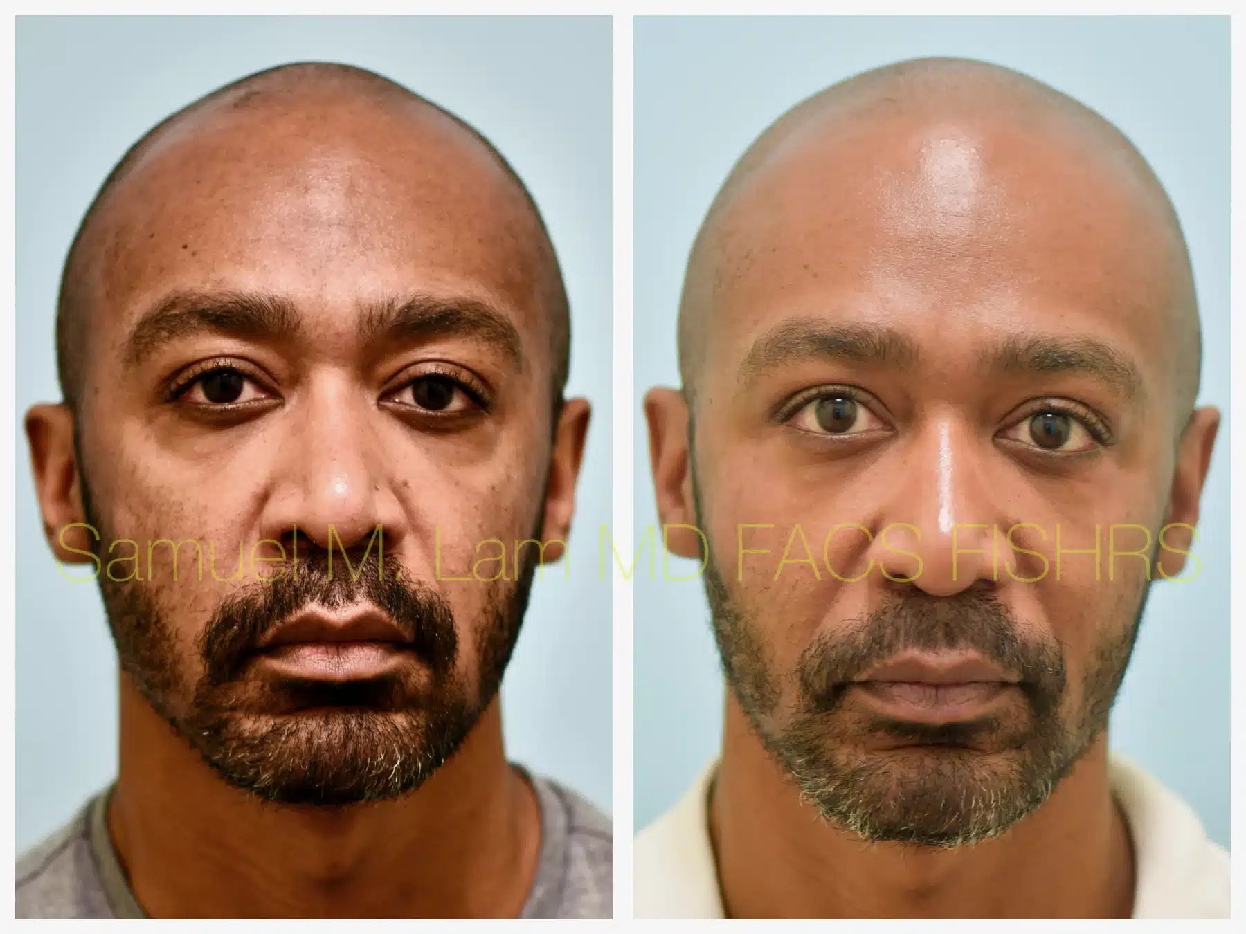 Fat Grafting and Blepharoplasty Before and After Photo by Dr. Lam in Plano TX Fat Grafting and Blepharoplasty Before and After Photo by Dr. Lam in Plano TX
