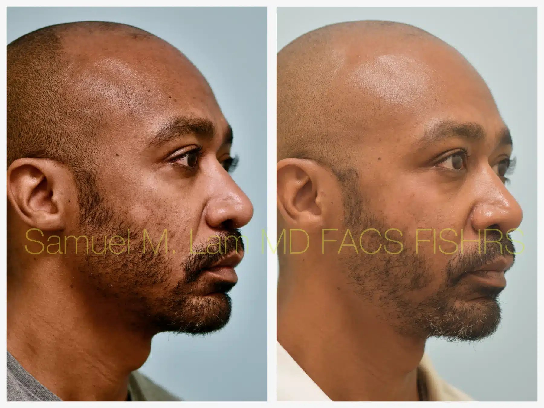 Fat Grafting and Blepharoplasty Before and After Photo by Dr. Lam in Plano TX Fat Grafting and Blepharoplasty Before and After Photo by Dr. Lam in Plano TX