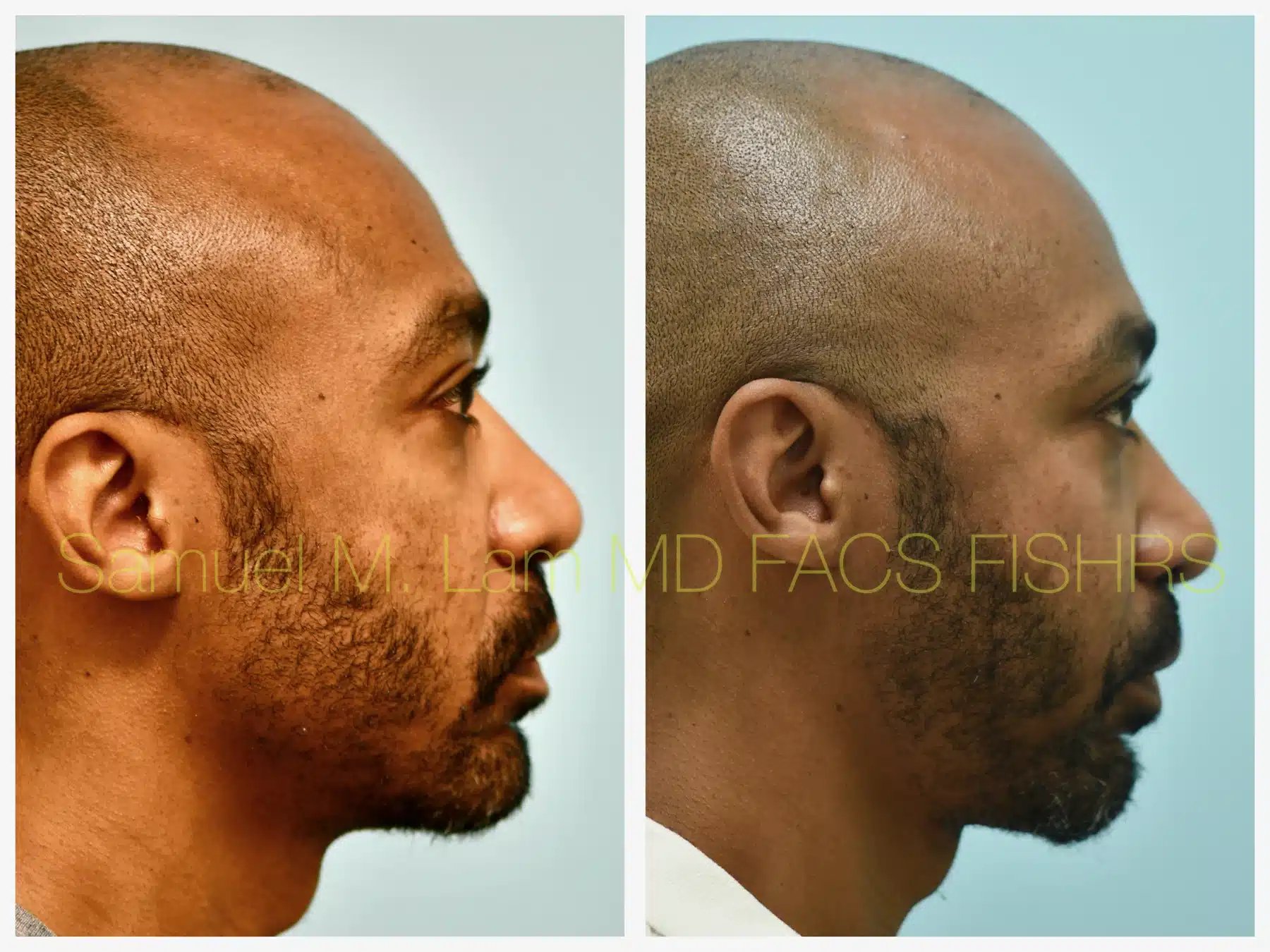 Fat Grafting and Blepharoplasty Before and After Photo by Dr. Lam in Plano TX Fat Grafting and Blepharoplasty Before and After Photo by Dr. Lam in Plano TX