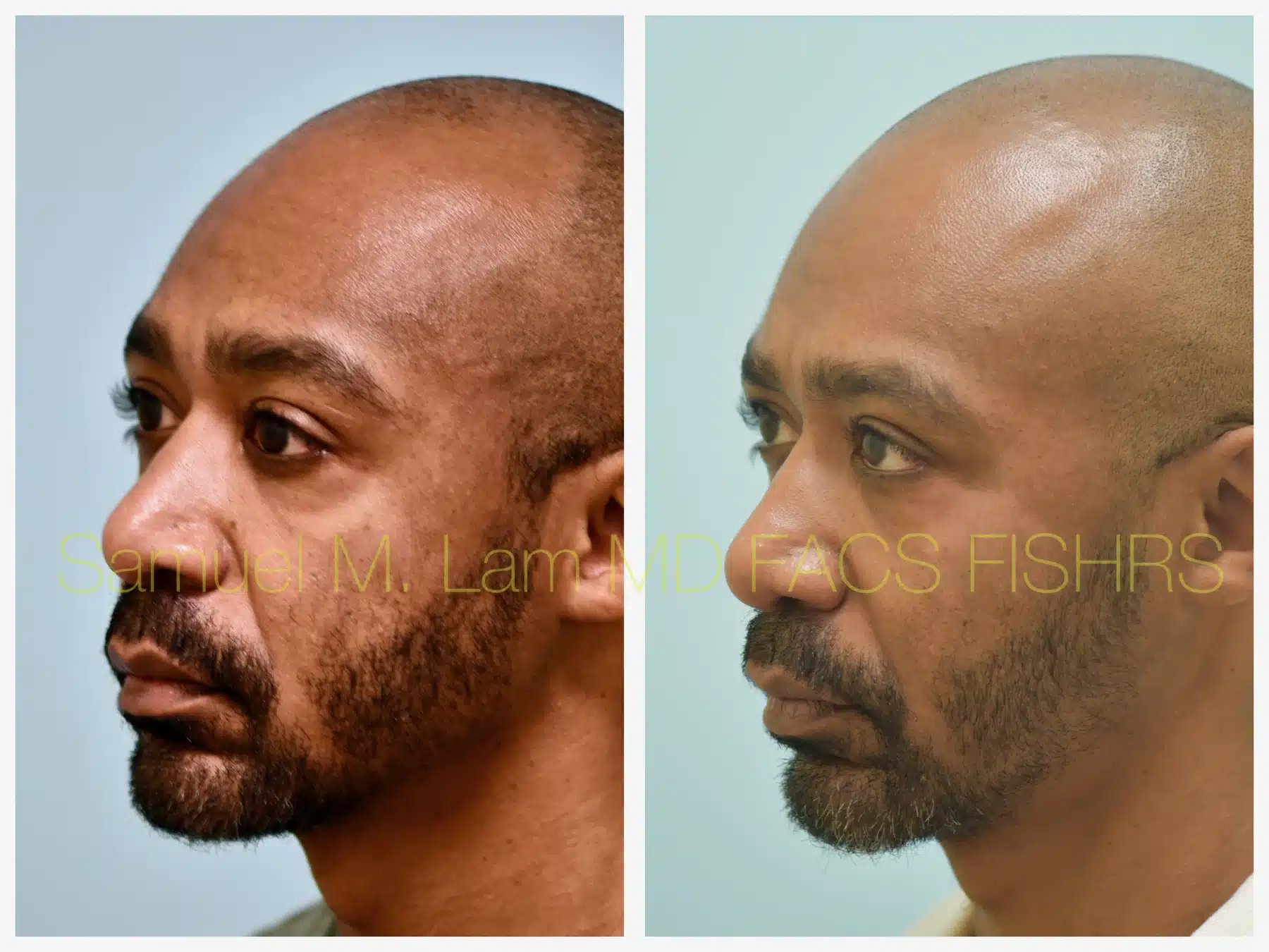 Fat Grafting and Blepharoplasty Before and After Photo by Dr. Lam in Plano TX Fat Grafting and Blepharoplasty Before and After Photo by Dr. Lam in Plano TX
