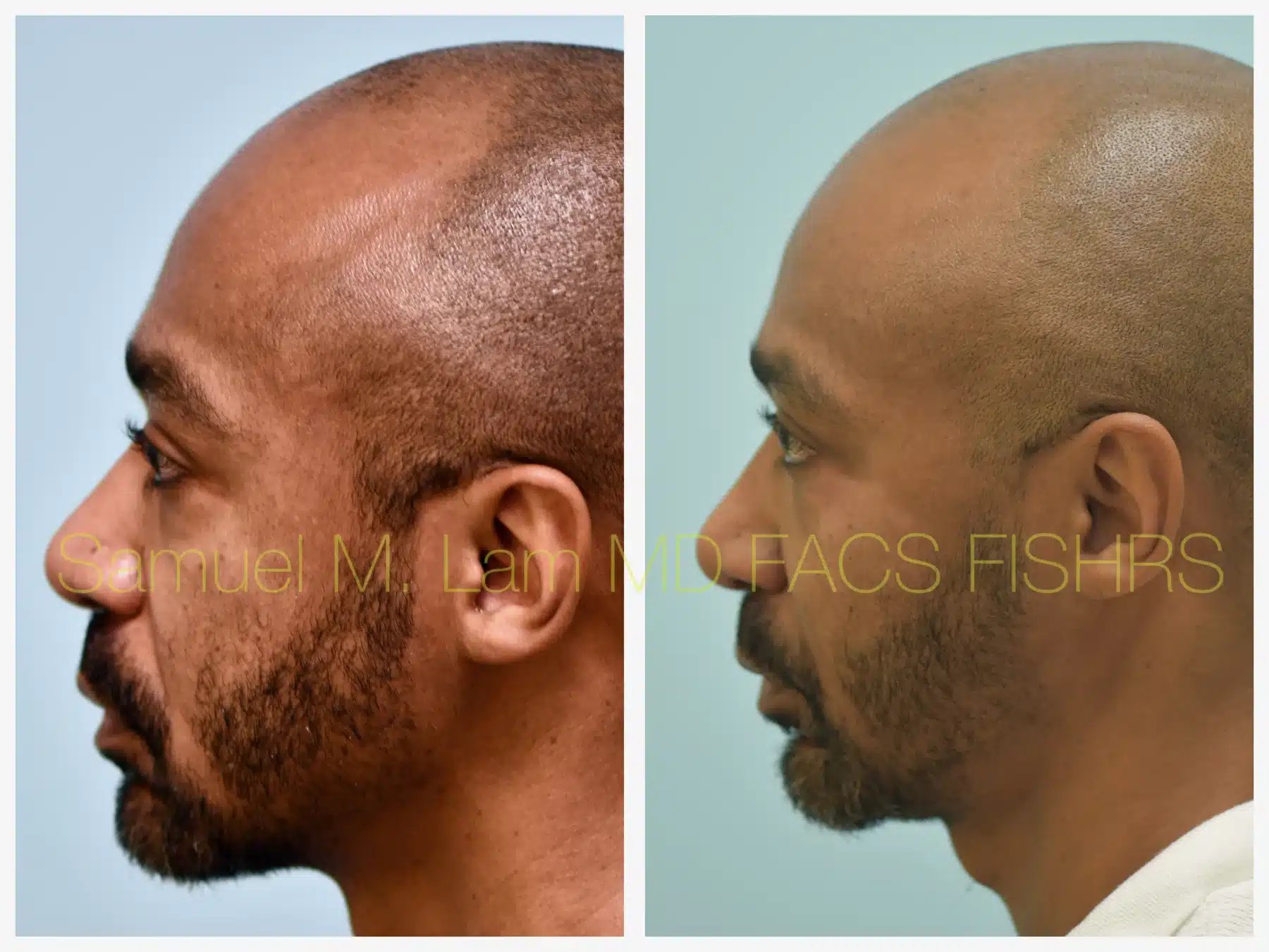Fat Grafting and Blepharoplasty Before and After Photo by Dr. Lam in Plano TX Fat Grafting and Blepharoplasty Before and After Photo by Dr. Lam in Plano TX