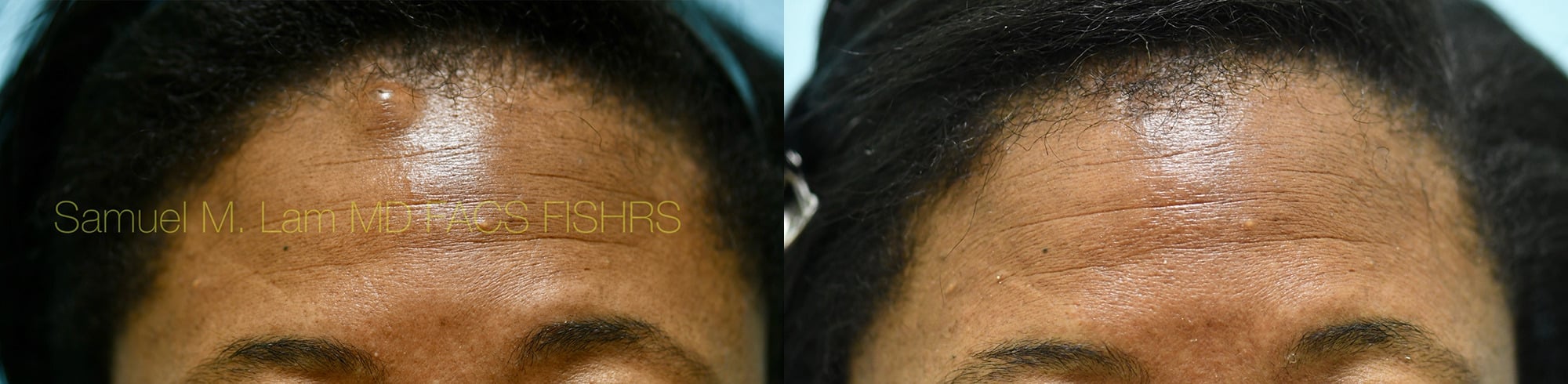 Mole Removal Before and After Photo by Dr. Lam in Plano, TX Mole Removal Before and After Photo by Dr. Lam in Plano, TX