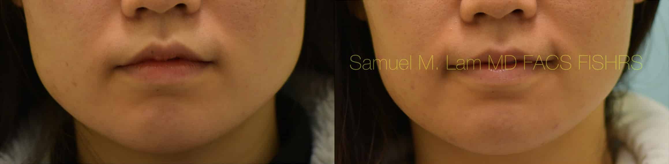 Botox Before and After Photo by Dr. Lam in Plano, TX