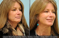 fillers-bxa25-th Botox Results Before and After