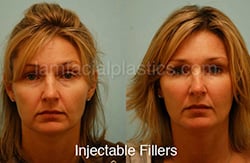 fillers-bxa26-th Botox Results Before and After