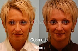 fillers-bxa33-th Botox Results Before and After