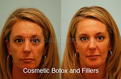 fillers-bxa42-th Botox Results Before and After