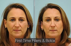 fillers-bxa7-th Botox Results Before and After