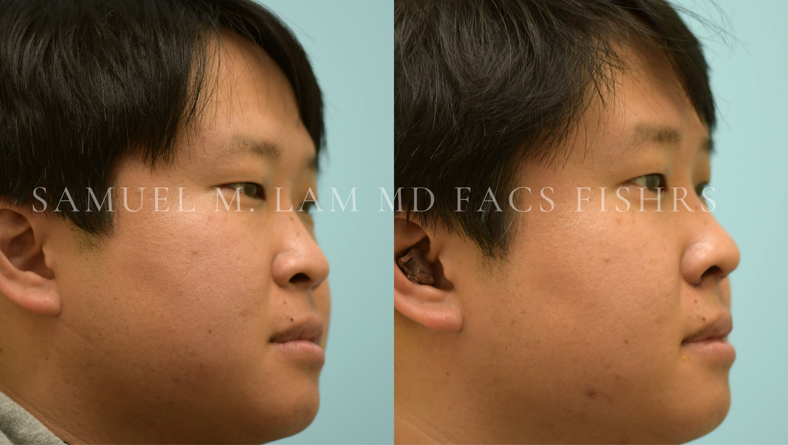 Rhinoplasty-Nose Job
