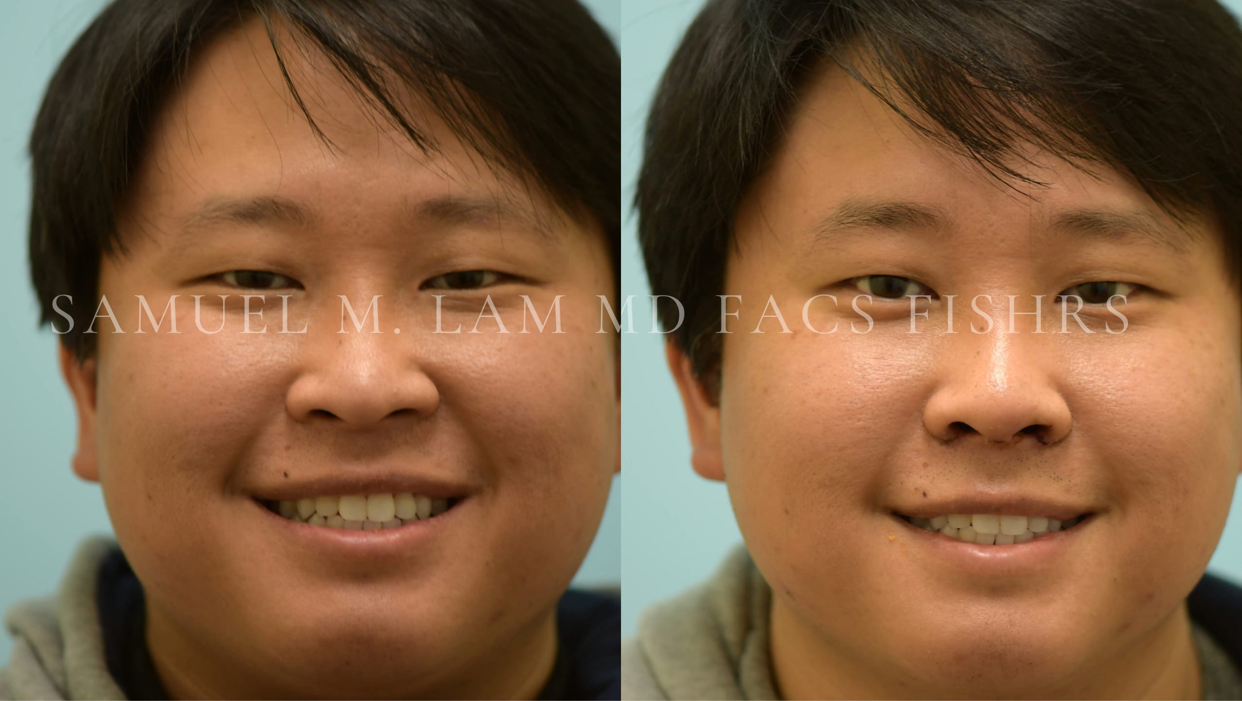 Rhinoplasty-Nose Job