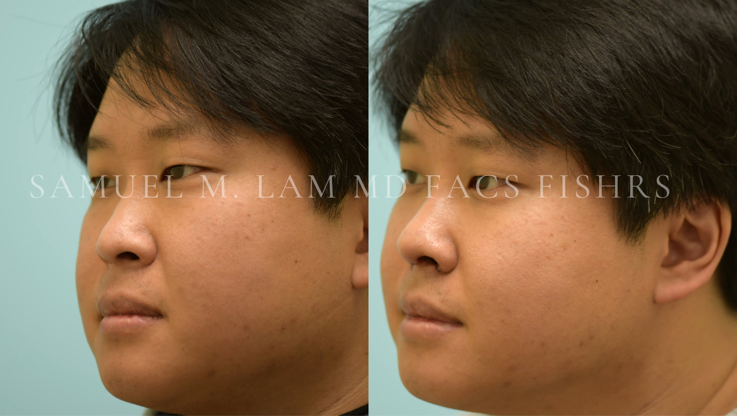 Rhinoplasty-Nose Job