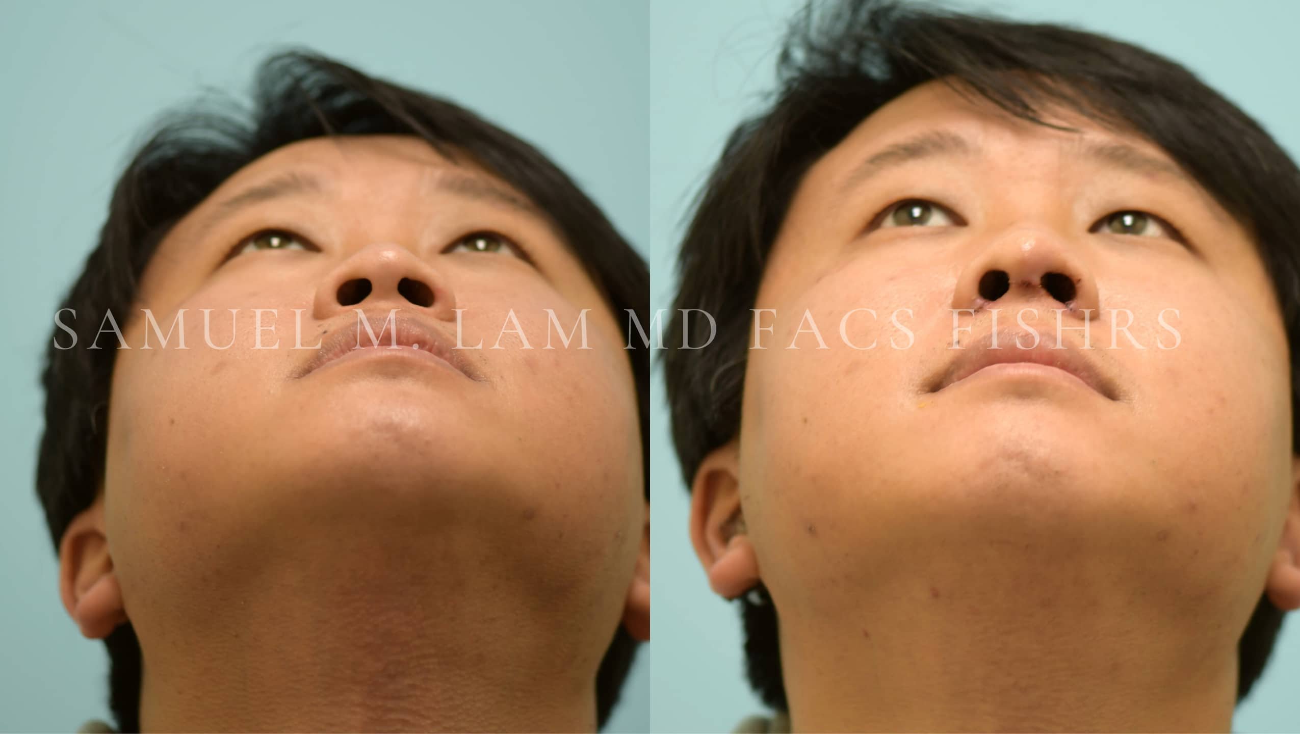 Rhinoplasty-Nose Job