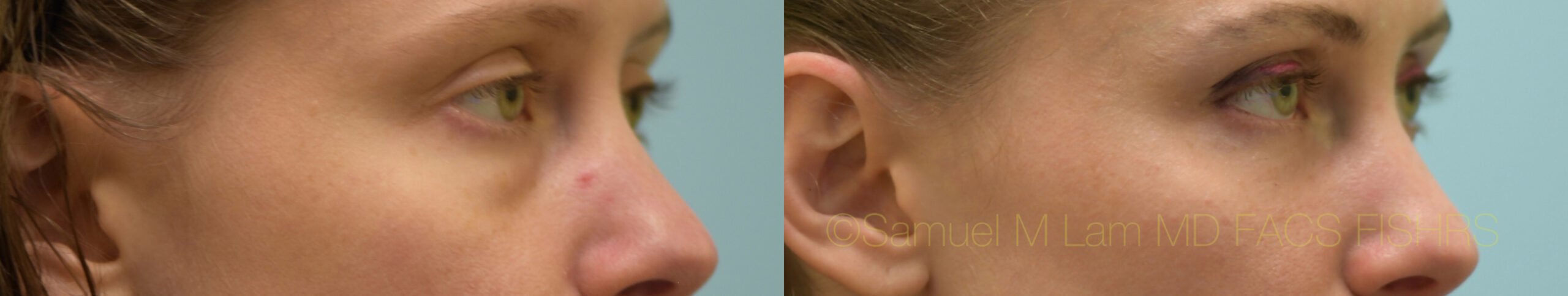 Eyelid Rejuvenation, Fat Grafting