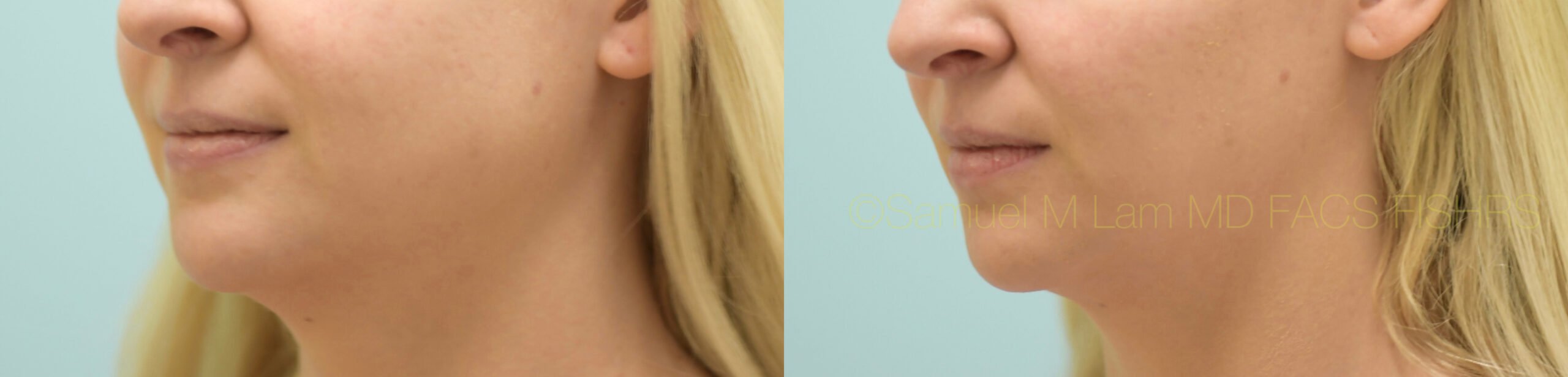 Botox Jaw Reduction Botox Jaw Reduction