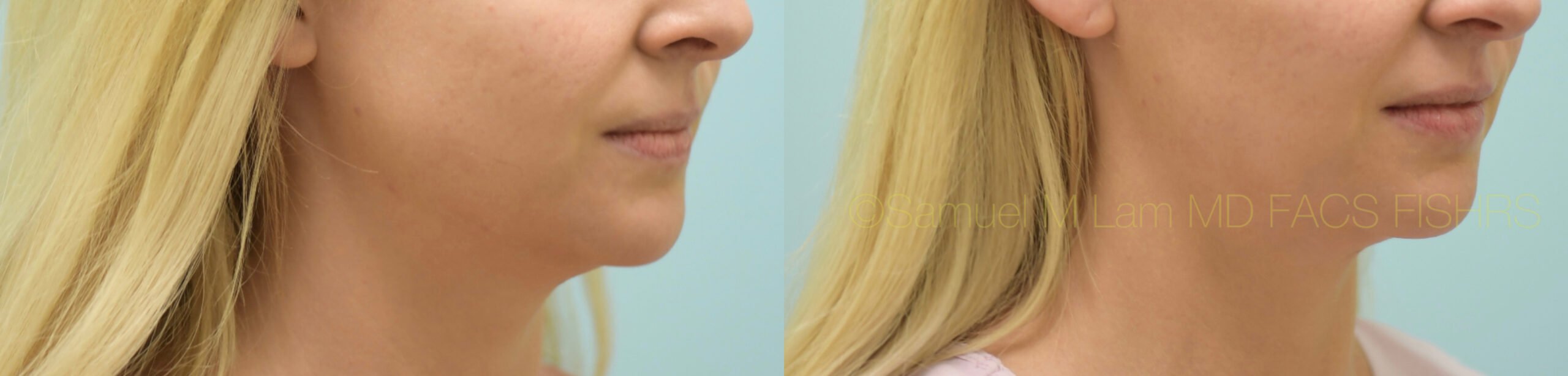 Botox Jaw Reduction Botox Jaw Reduction