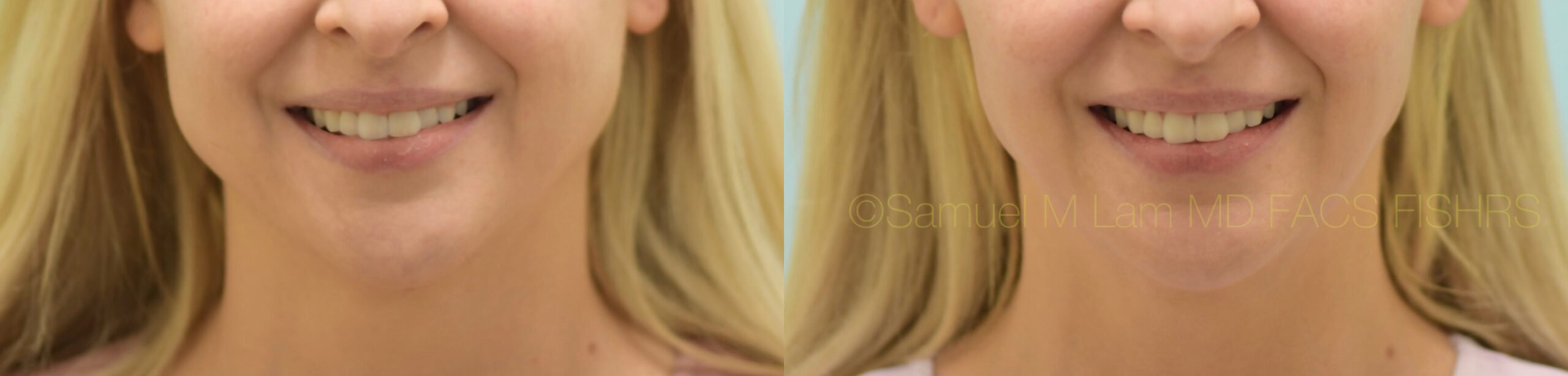 Botox Jaw Reduction Botox Jaw Reduction