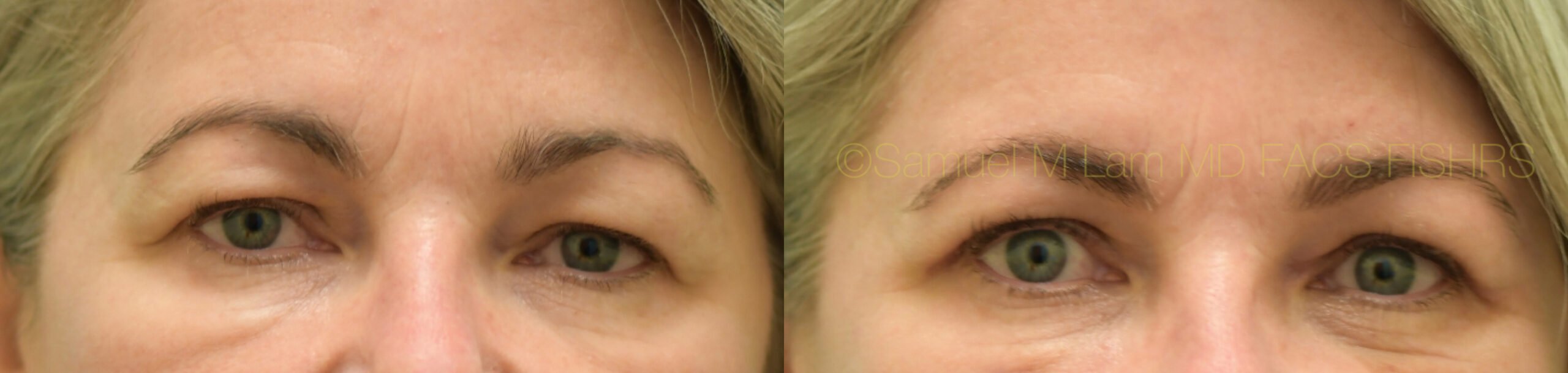 Eyelid Rejuvenation Eyelid Rejuvenation