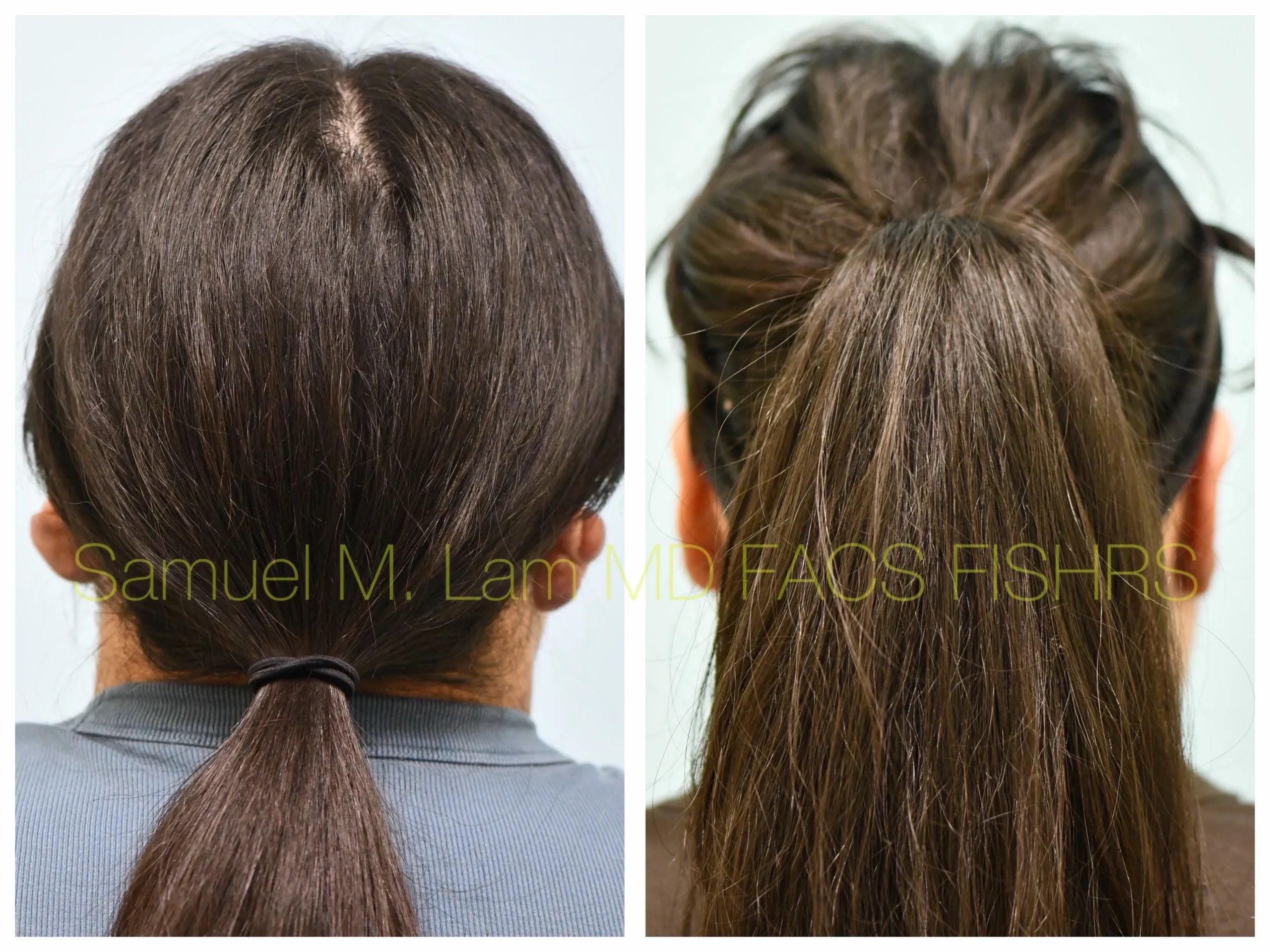 back view keloids removal before and after photo by Dr. Sam Lam back view keloids removal before and after photo by Dr. Sam Lam
