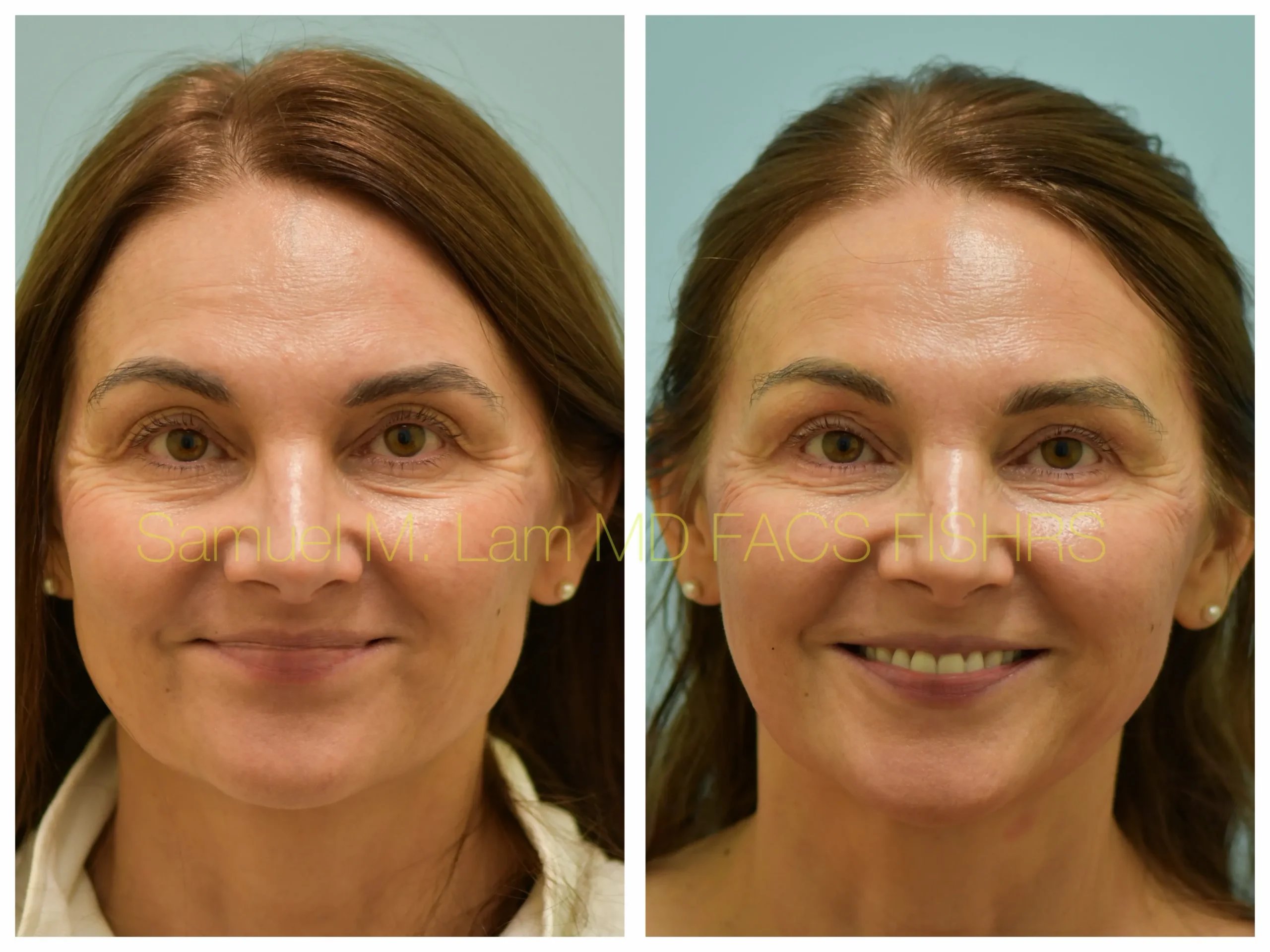 front smiling view blepharoplasty and facial fat grafting before and after photo by Dr. Sam Lam front smiling view blepharoplasty and facial fat grafting before and after photo by Dr. Sam Lam