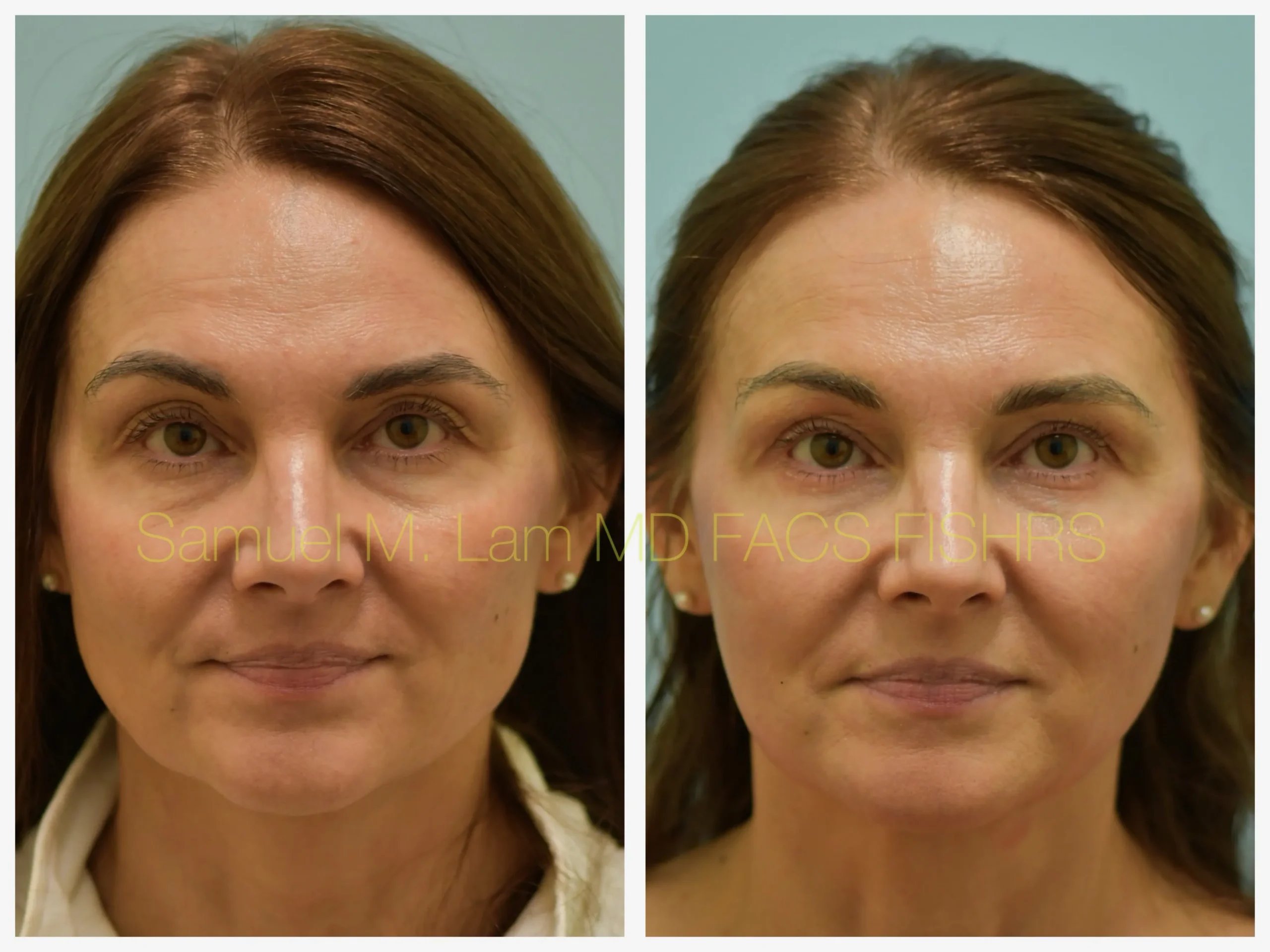 front view blepharoplasty and facial fat grafting before and after photo by Dr. Sam Lam front view blepharoplasty and facial fat grafting before and after photo by Dr. Sam Lam