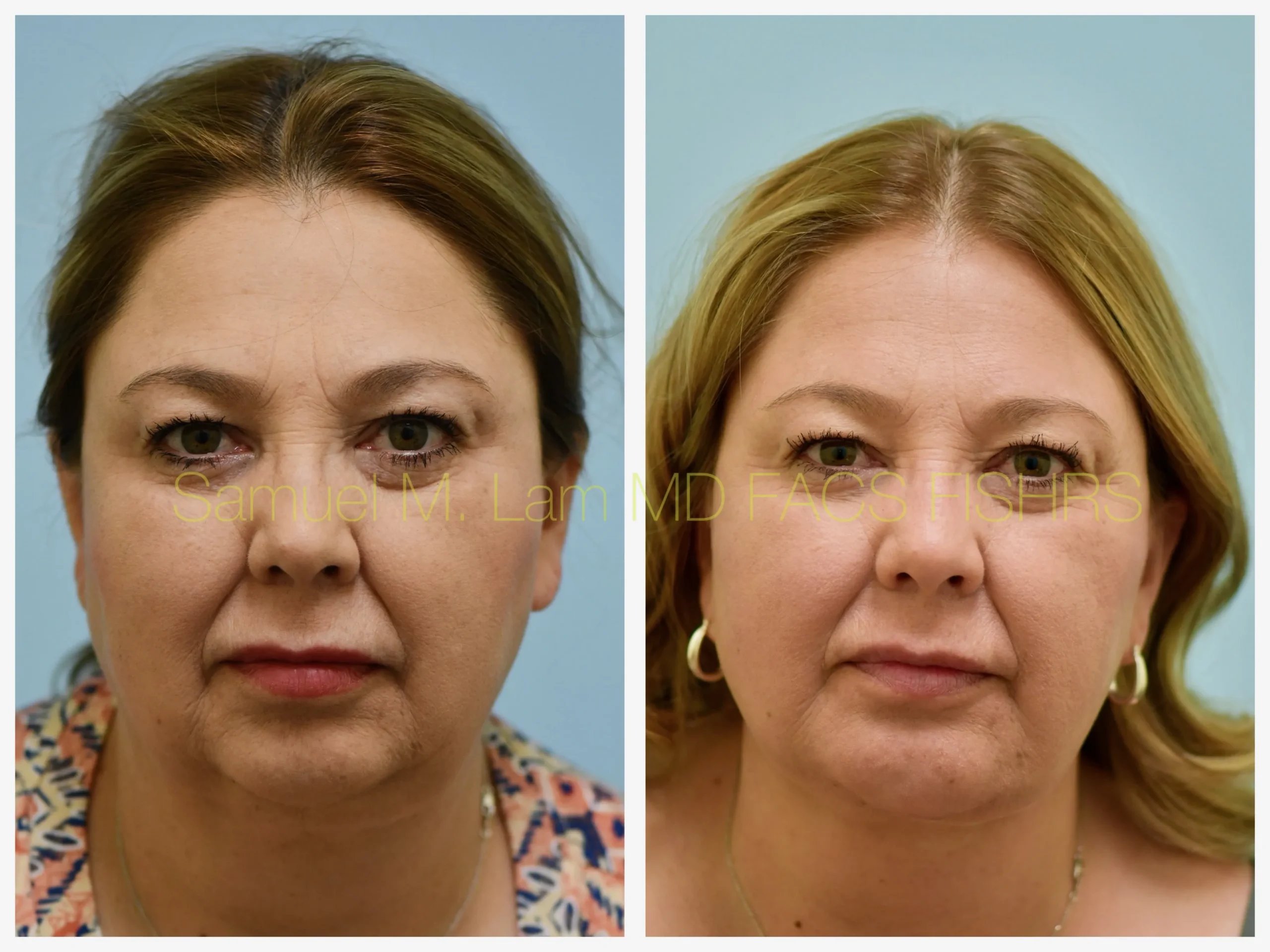 front view face and neck lift and chin implant before and after photo by Dr. Sam Lam front view face and neck lift and chin implant before and after photo by Dr. Sam Lam