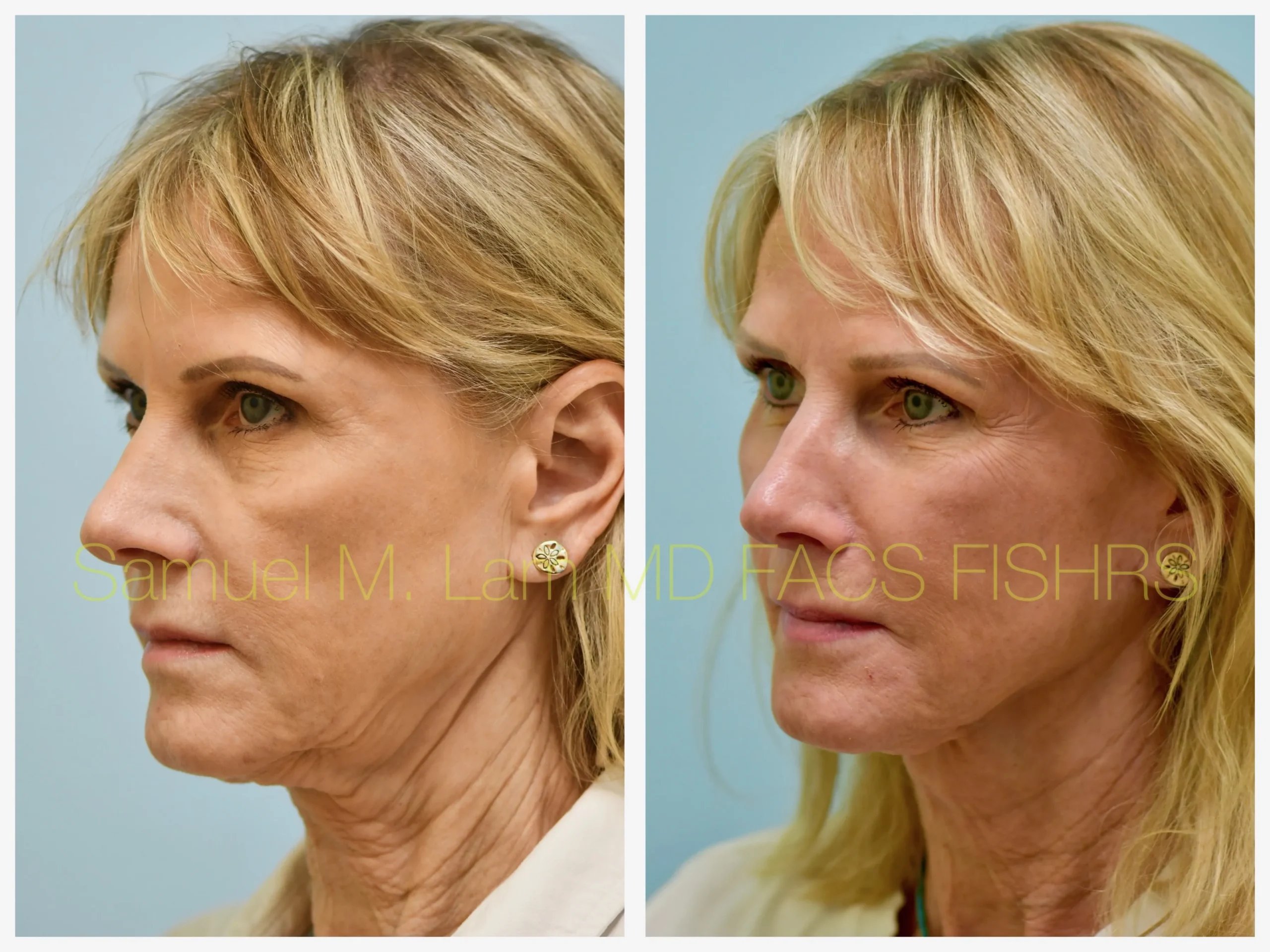 left oblique view deep plane facelift before and after photo by Dr. Sam Lam