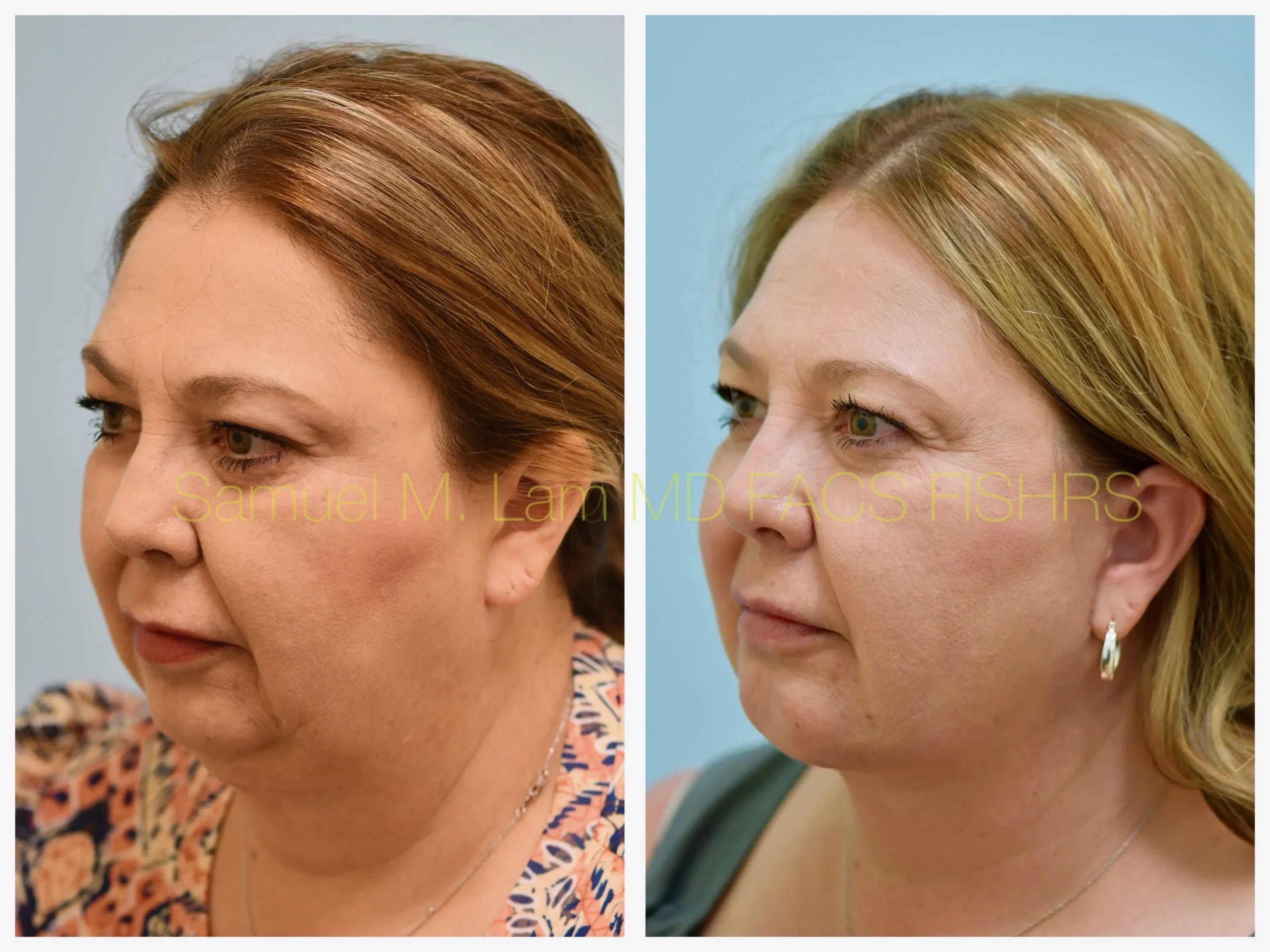 left oblique view face and neck lift and chin implant before and after photo by Dr. Sam Lam left oblique view face and neck lift and chin implant before and after photo by Dr. Sam Lam