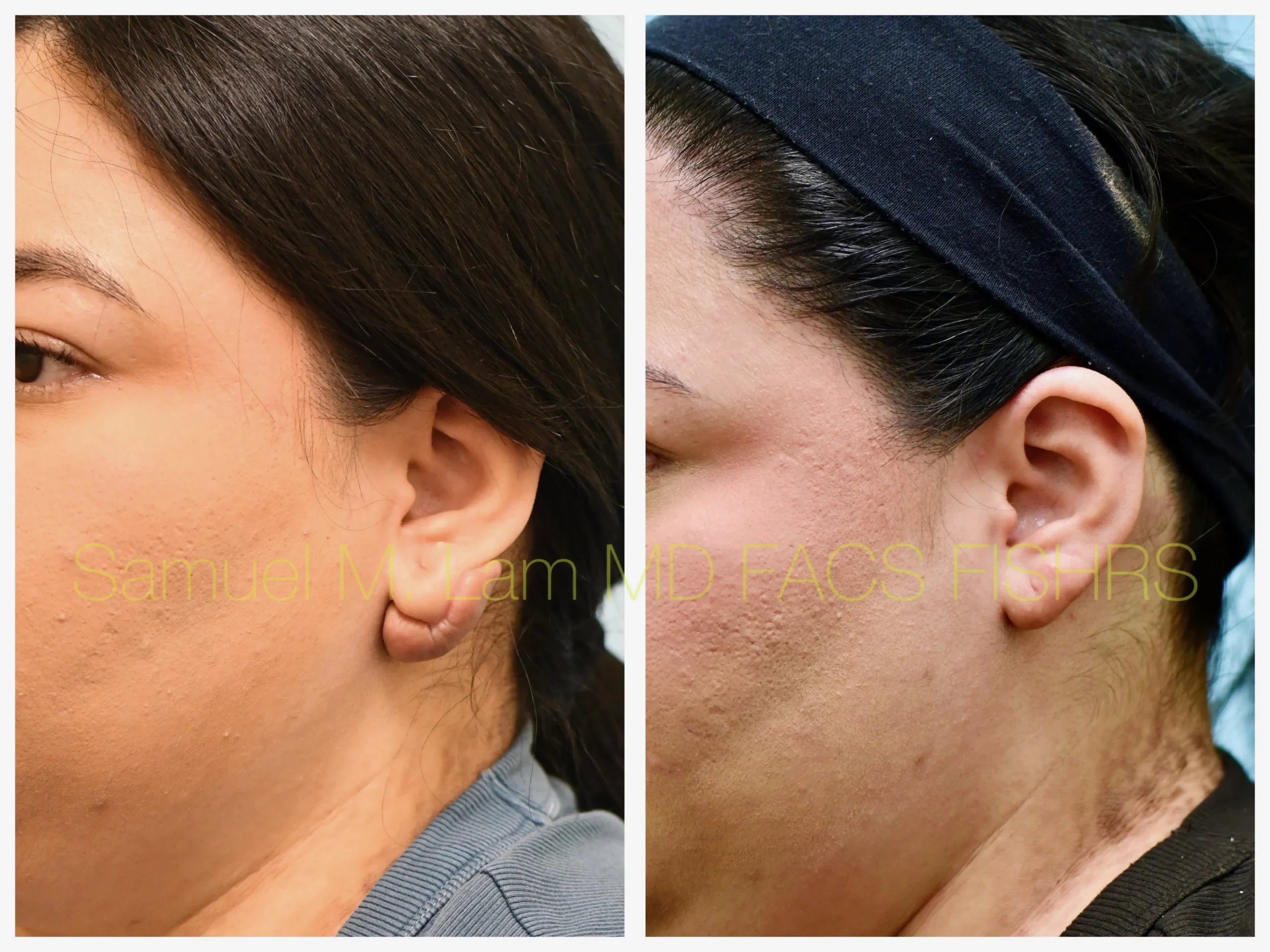 left oblique view keloids removal before and after photo by Dr. Sam Lam left oblique view keloids removal before and after photo by Dr. Sam Lam