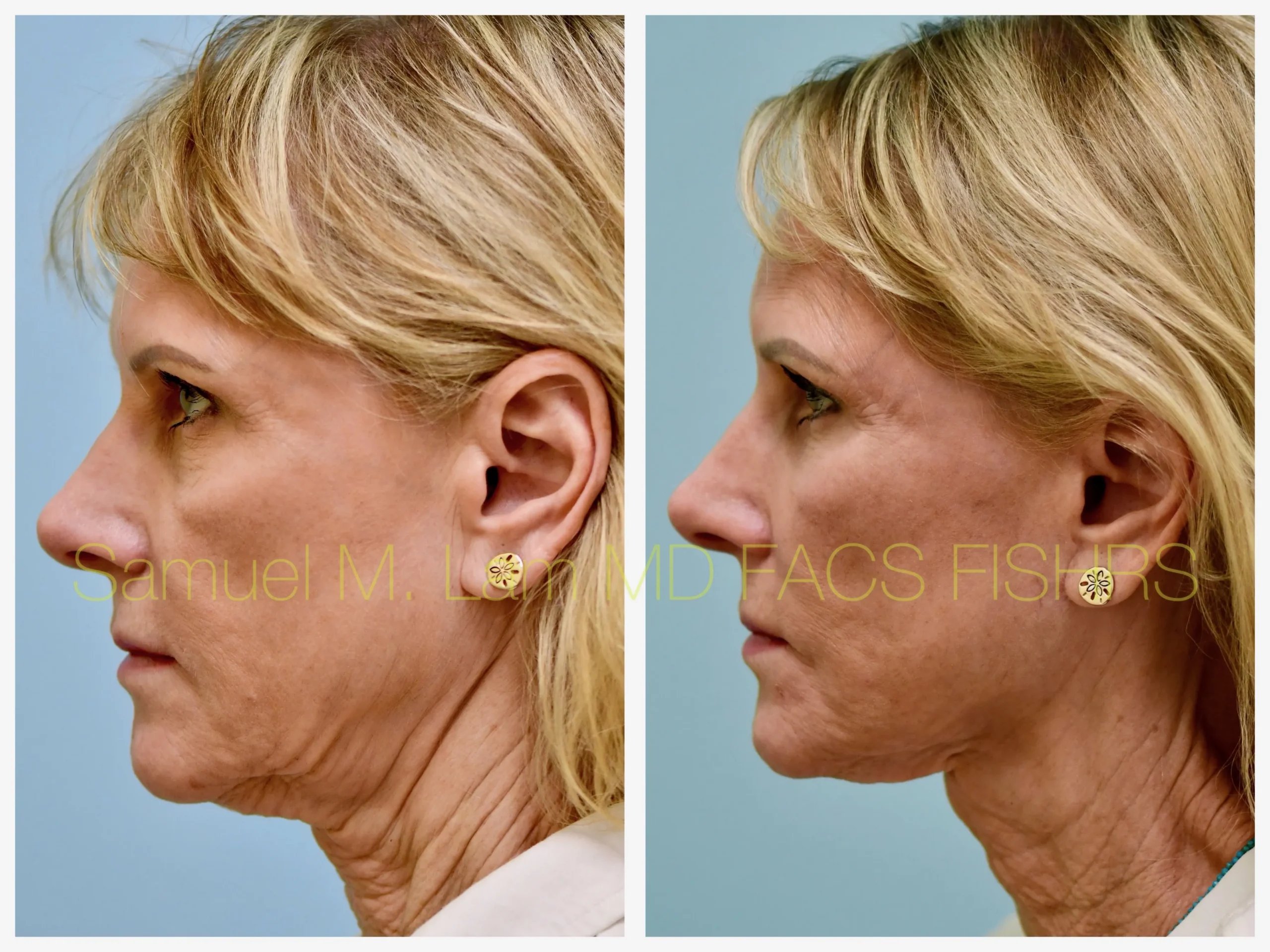 left side view deep plane facelift before and after photo by Dr. Sam Lam