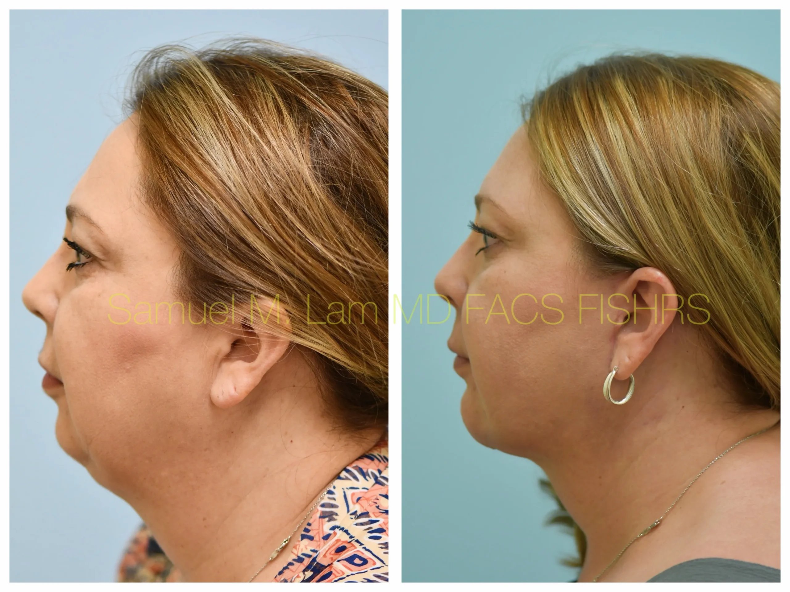 left side view face and neck lift and chin implant before and after photo by Dr. Sam Lam left side view face and neck lift and chin implant before and after photo by Dr. Sam Lam
