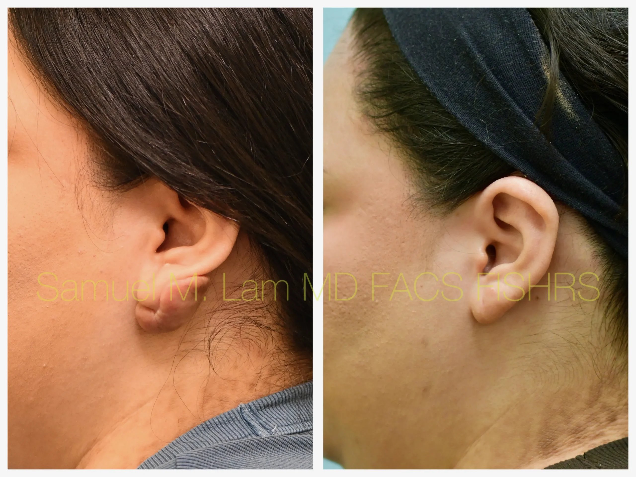 left side view keloids removal before and after photo by Dr. Sam Lam left side view keloids removal before and after photo by Dr. Sam Lam